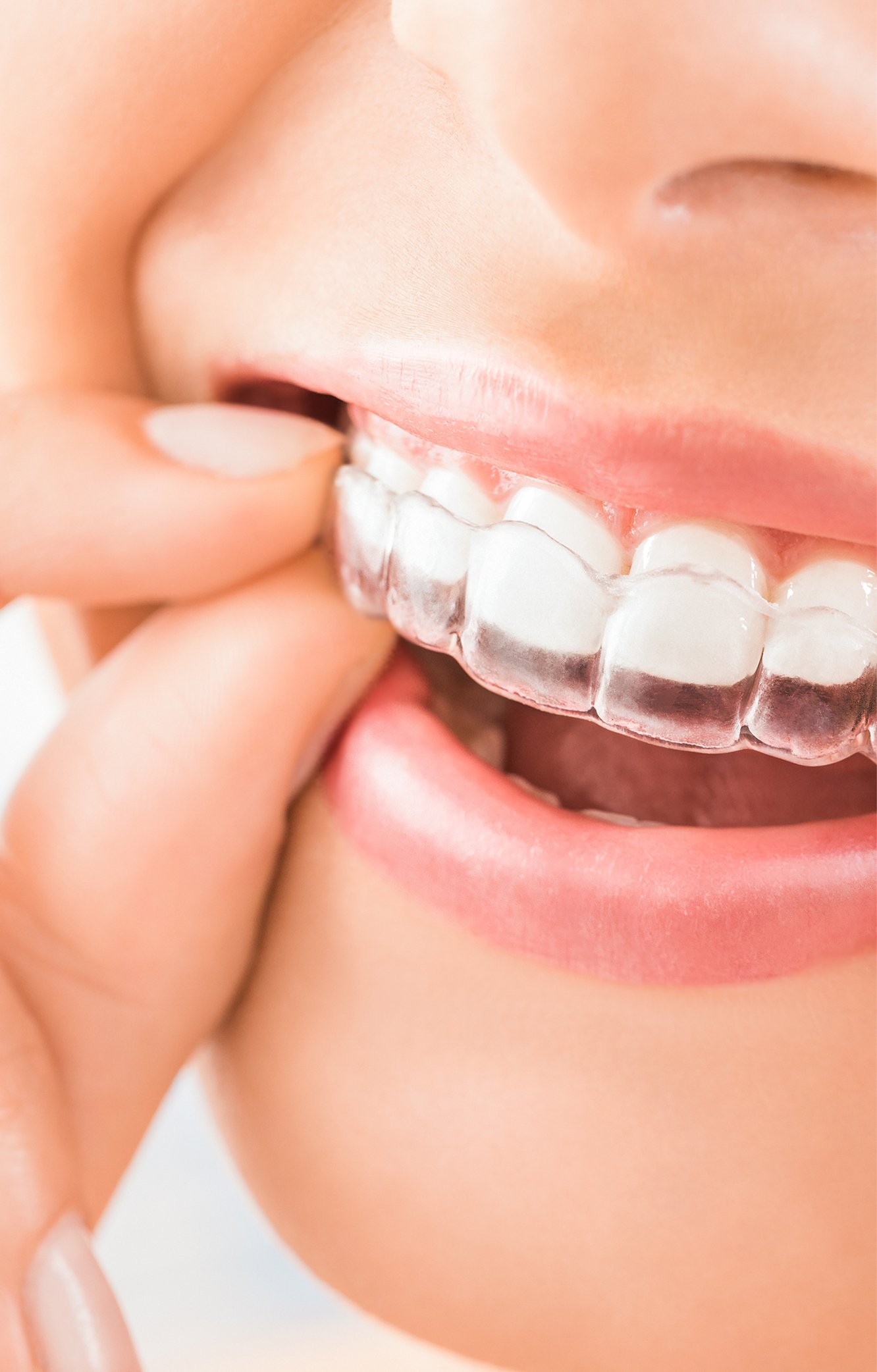 Lausanne Smile Dental Alignment Modern Treatment