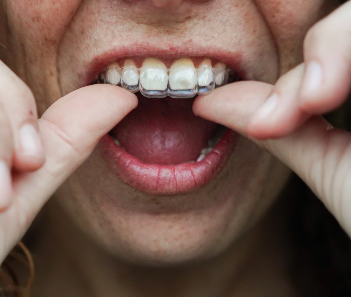 Lausanne Smile Besoins Soins Alignement Dents