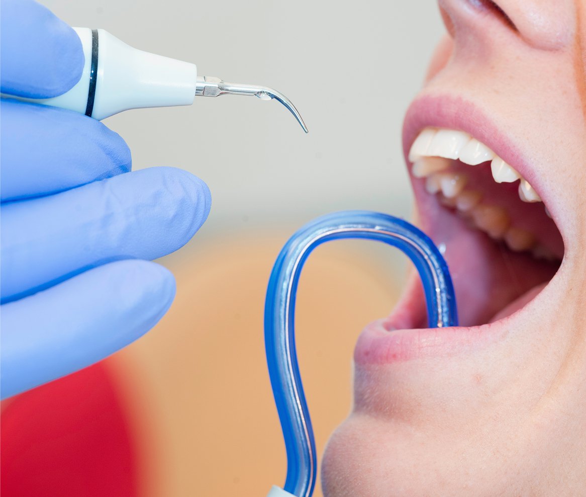 Lausanne Smile Besoins Soins Detartrage