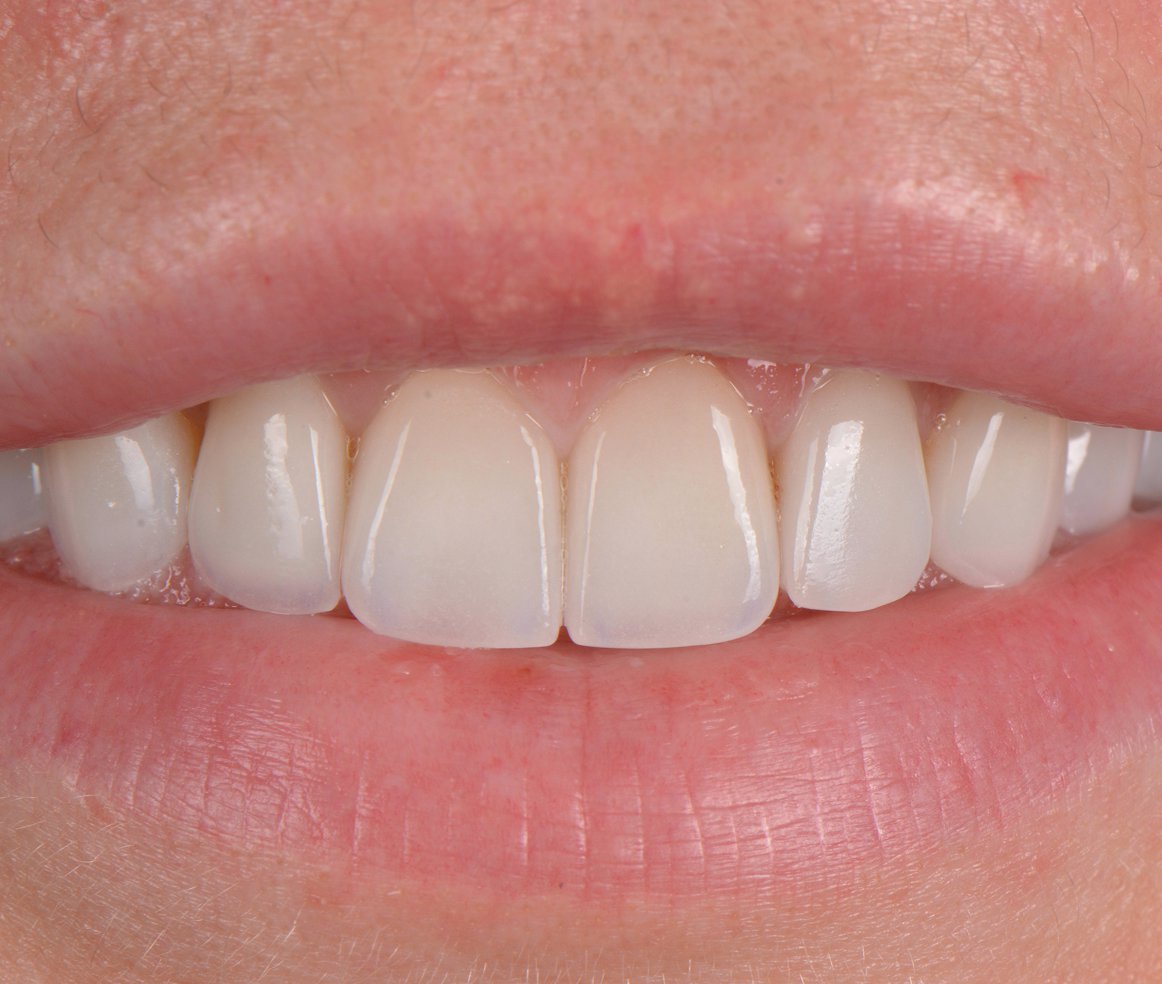 Lausanne Smile Besoins Soins Facettes Dentaires