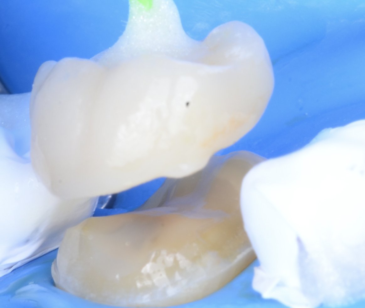 Lausanne Smile Besoins Soins Remplacement Plombages