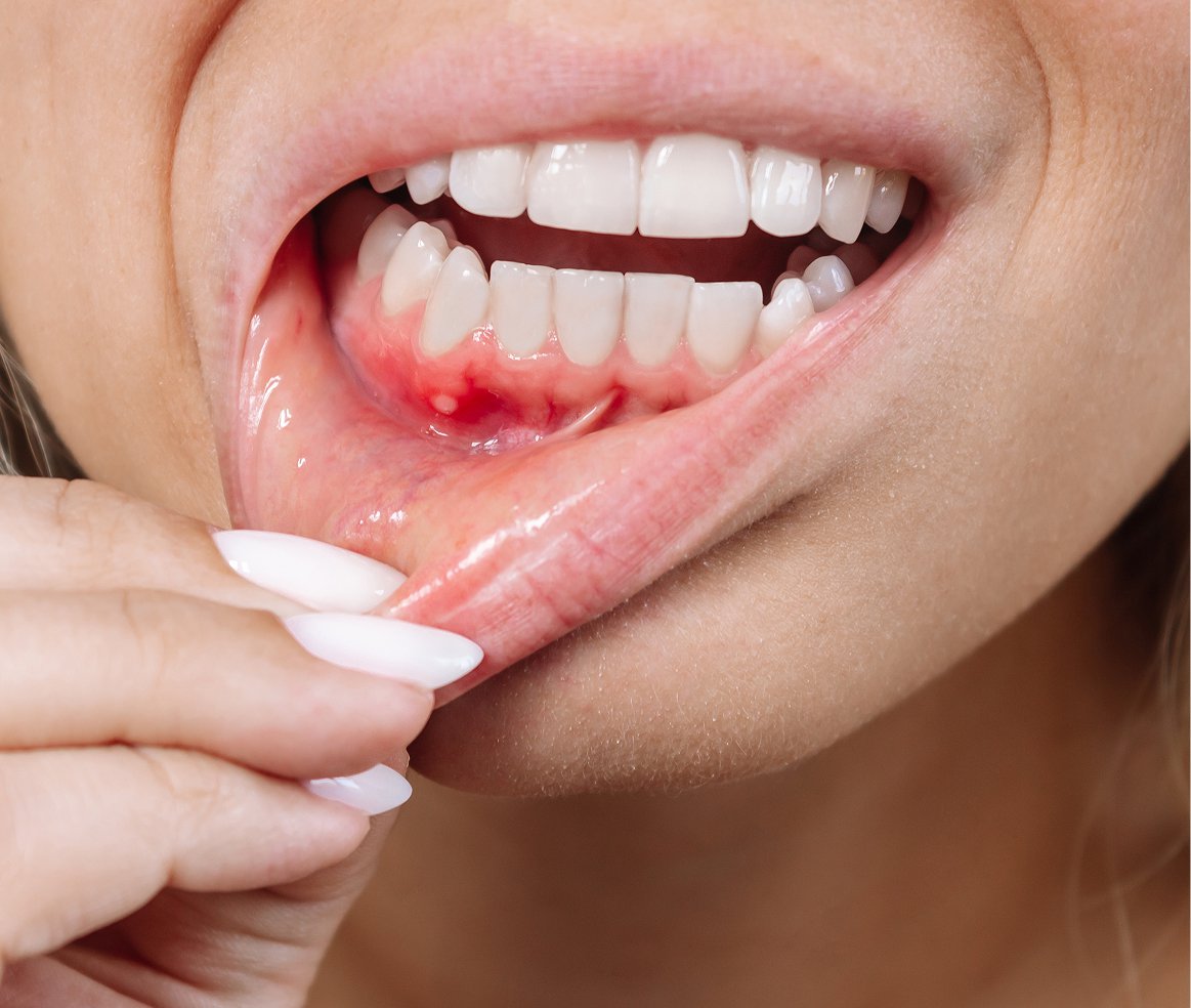 Lausanne Smile Besoins Soins Saignement Gencives