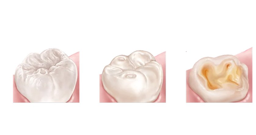 Lausanne Smile Erosions Dentaires Schema Erosions