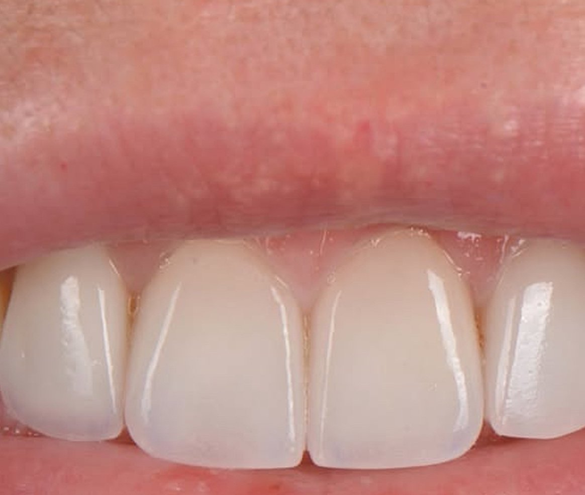 Lausanne Smile Services Dentaire Facette Dentaire