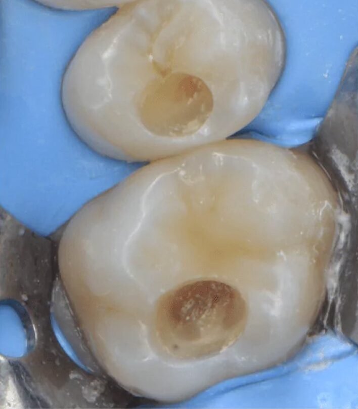 Lausanne Smile Traitement Caries Composite
