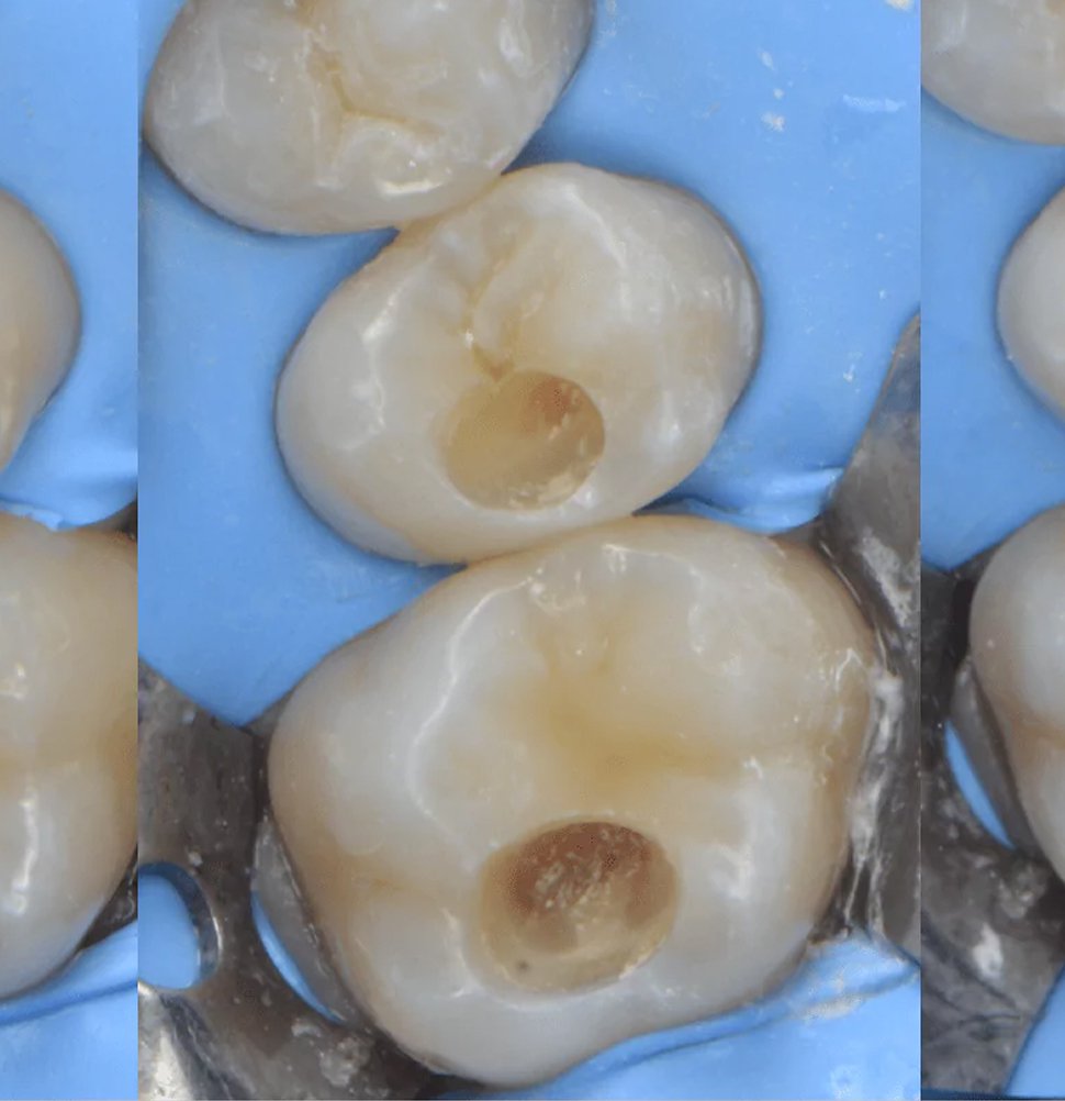 Lausanne Smile Caries Treatment Composite