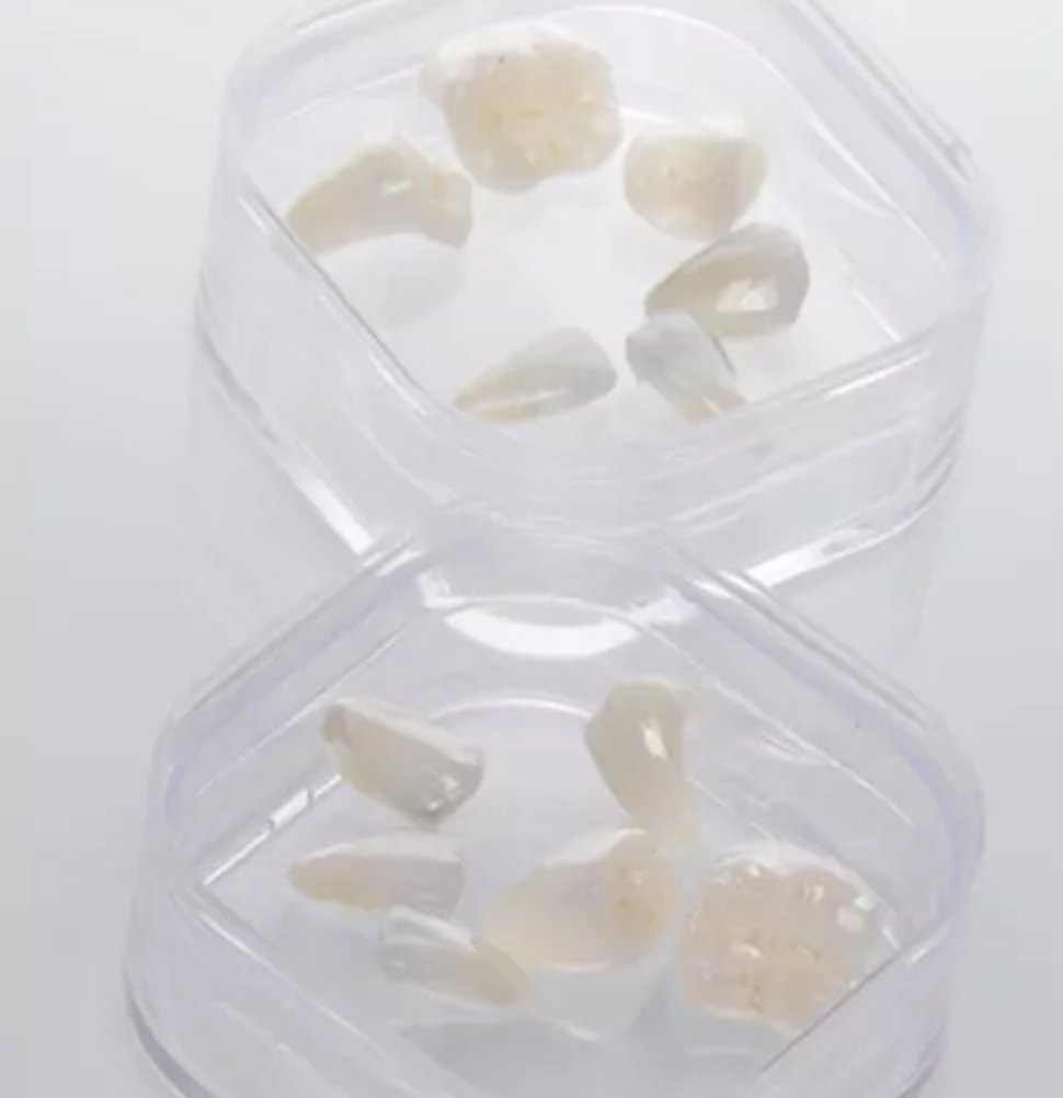 Lausanne Smile Caries Treatment Inlays
