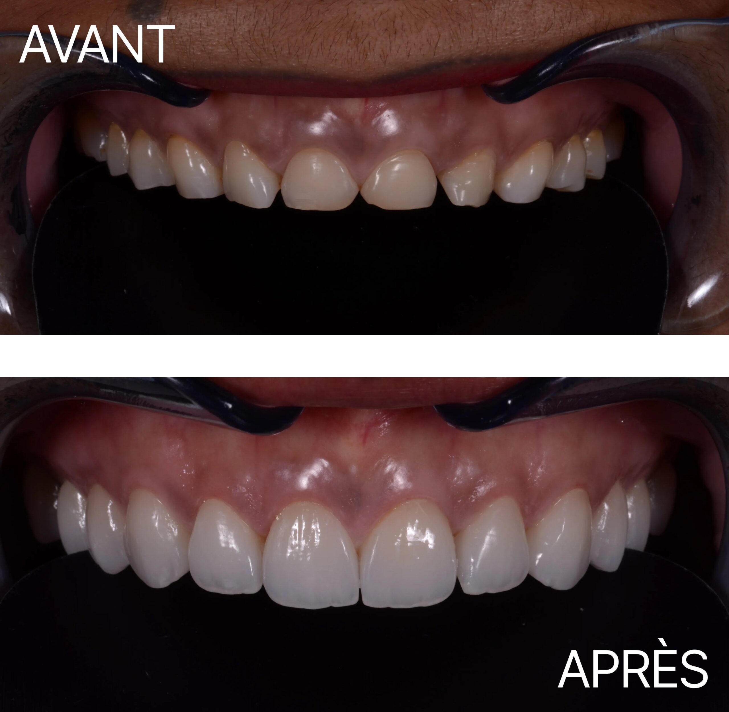 Lausanne Smile Avant Apres Cas Erosion Usure