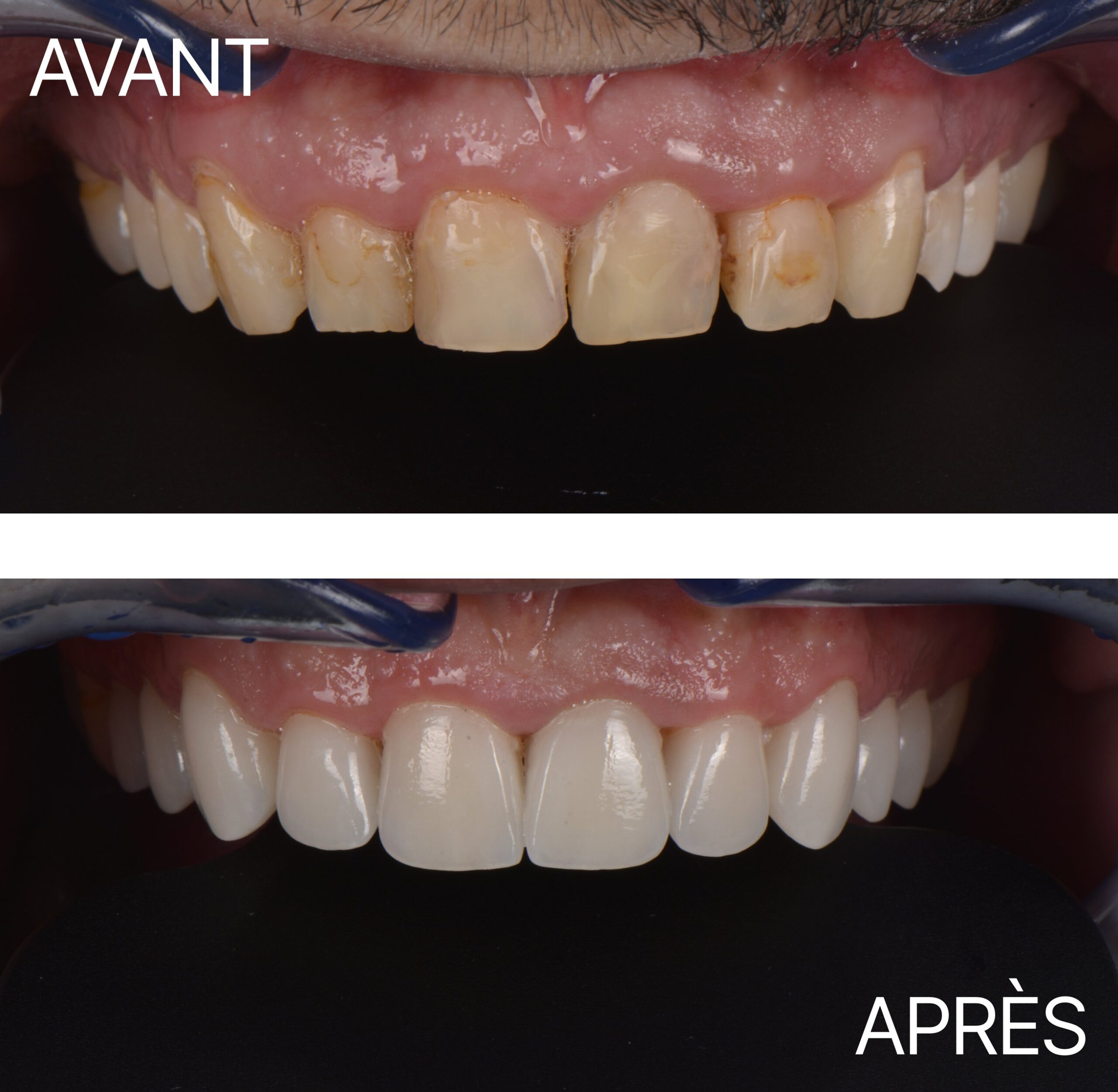 Lausanne Smile Avant Apres Cas Facette 11