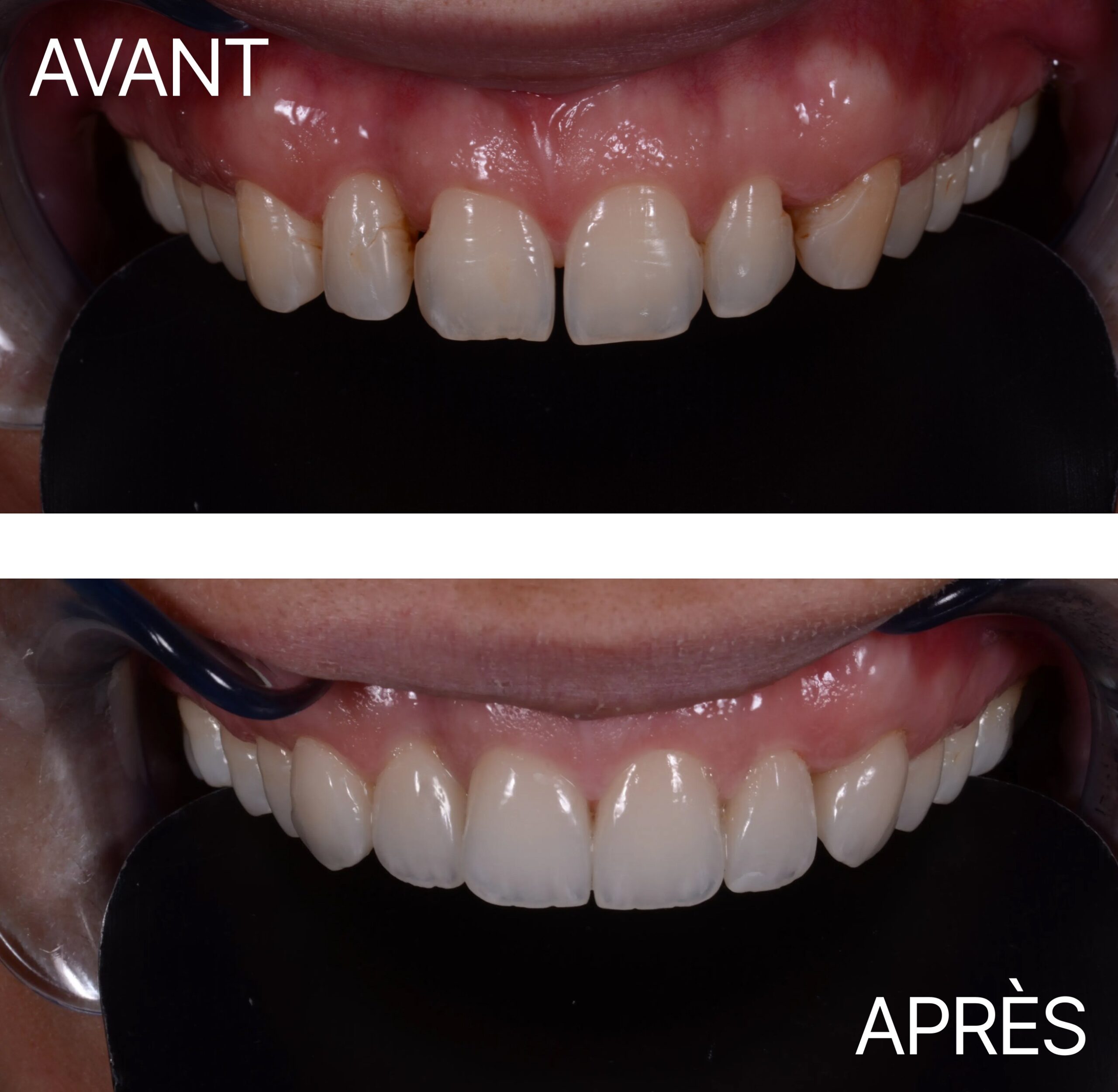Lausanne Smile Avant Apres Cas Facette 21