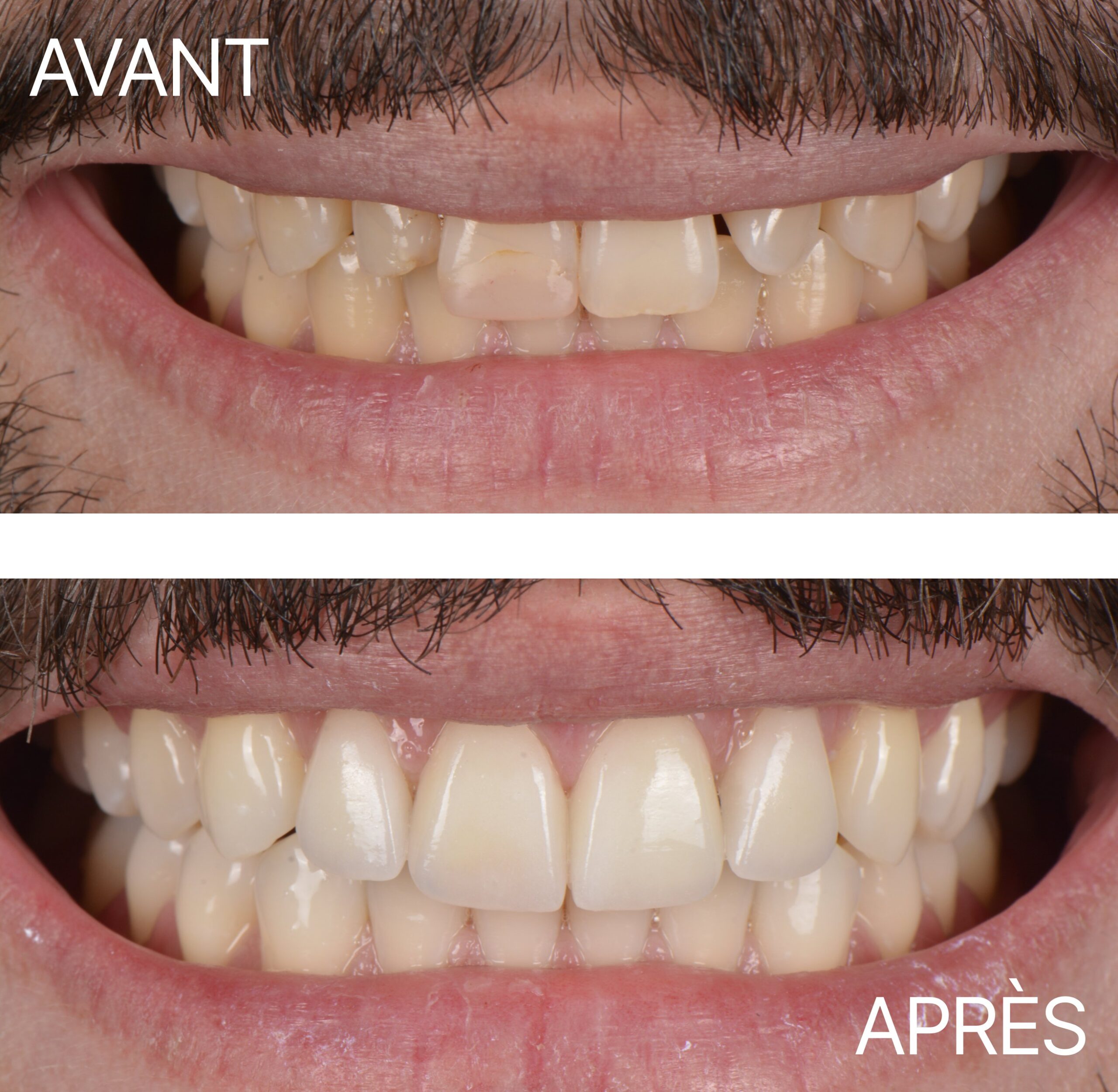 Lausanne Smile Avant Apres Cas Facette 3
