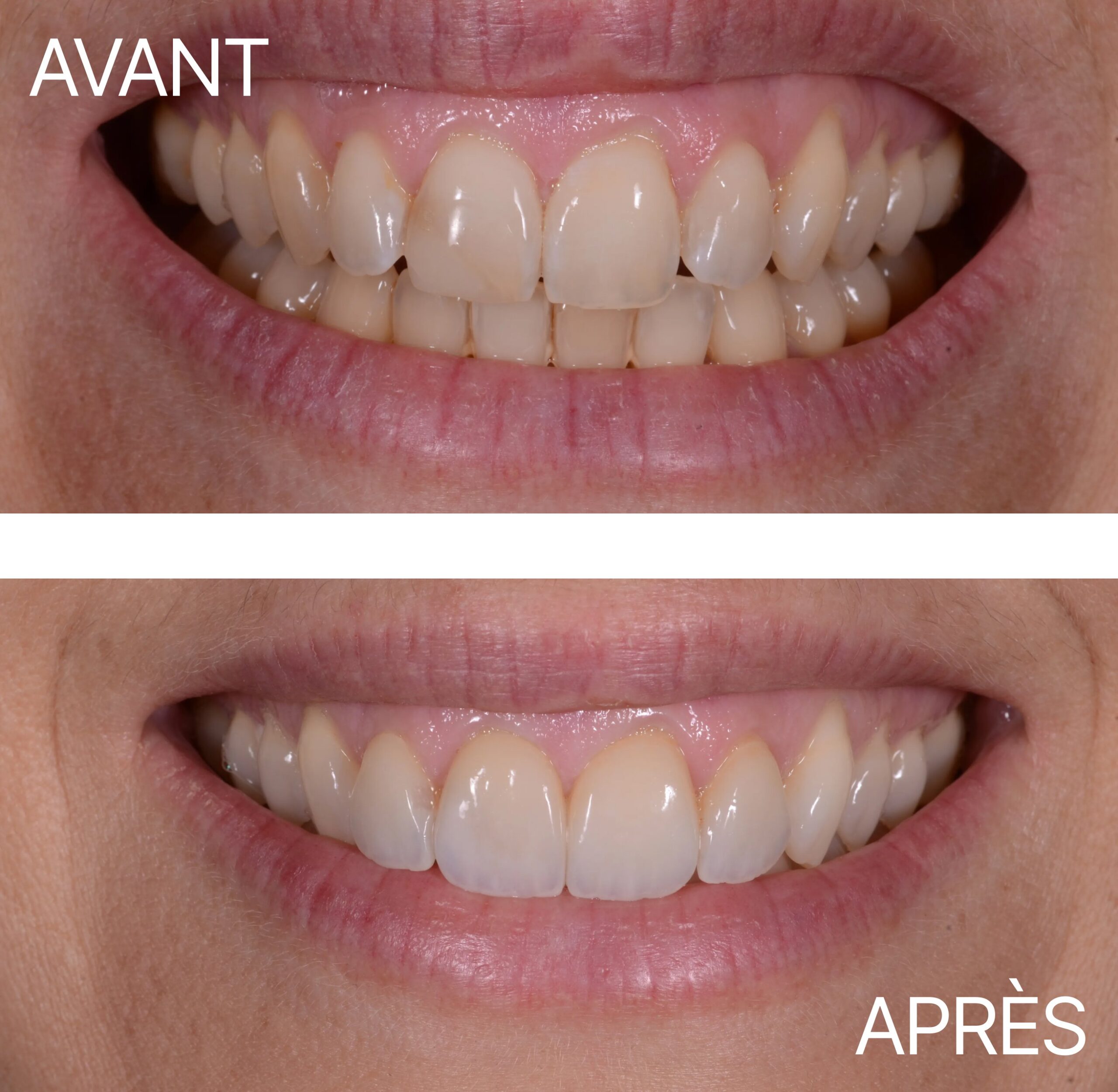 Lausanne Smile Avant Apres Cas Facette 4