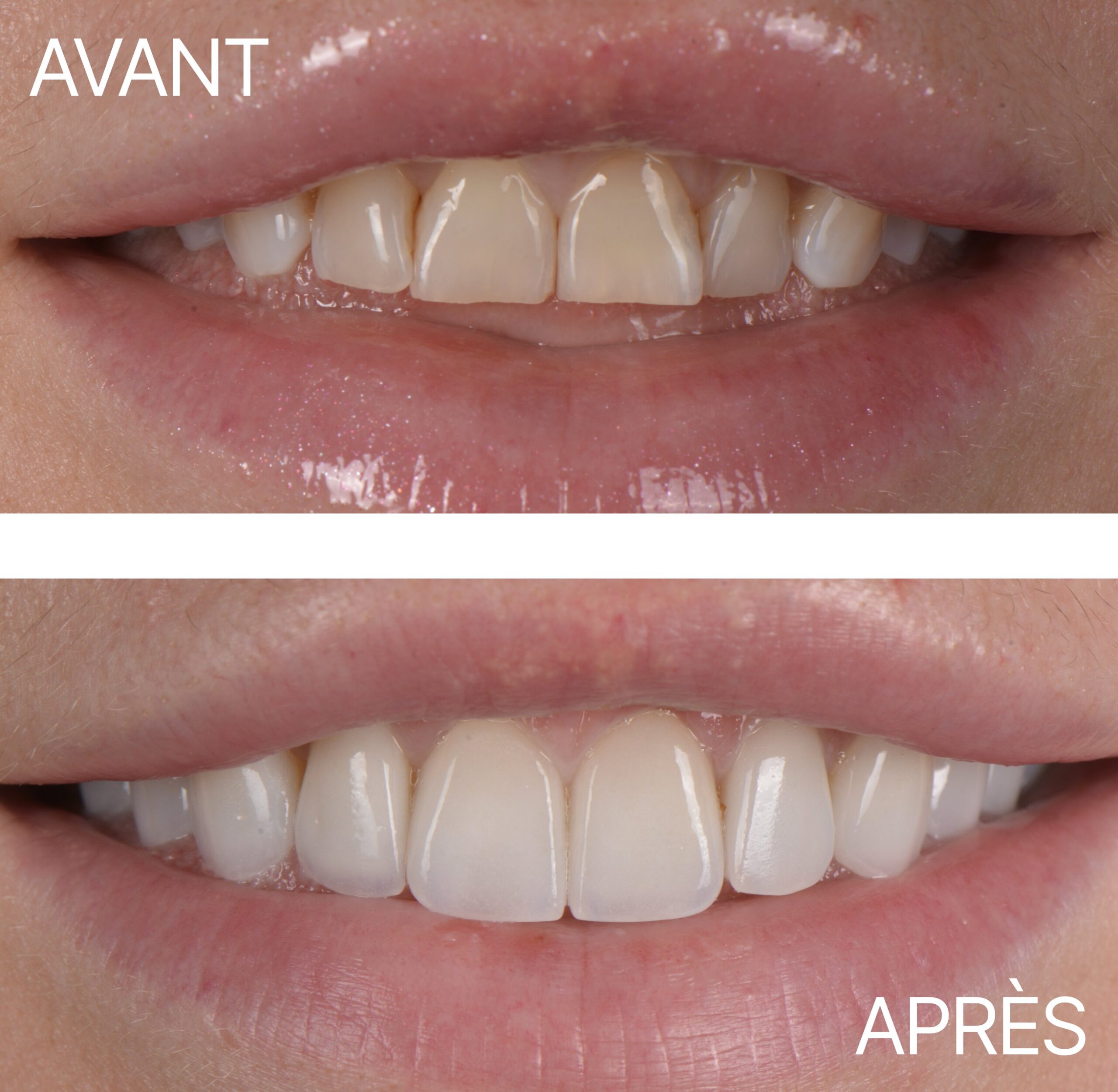 Lausanne Smile Avant Apres Cas Facette 5