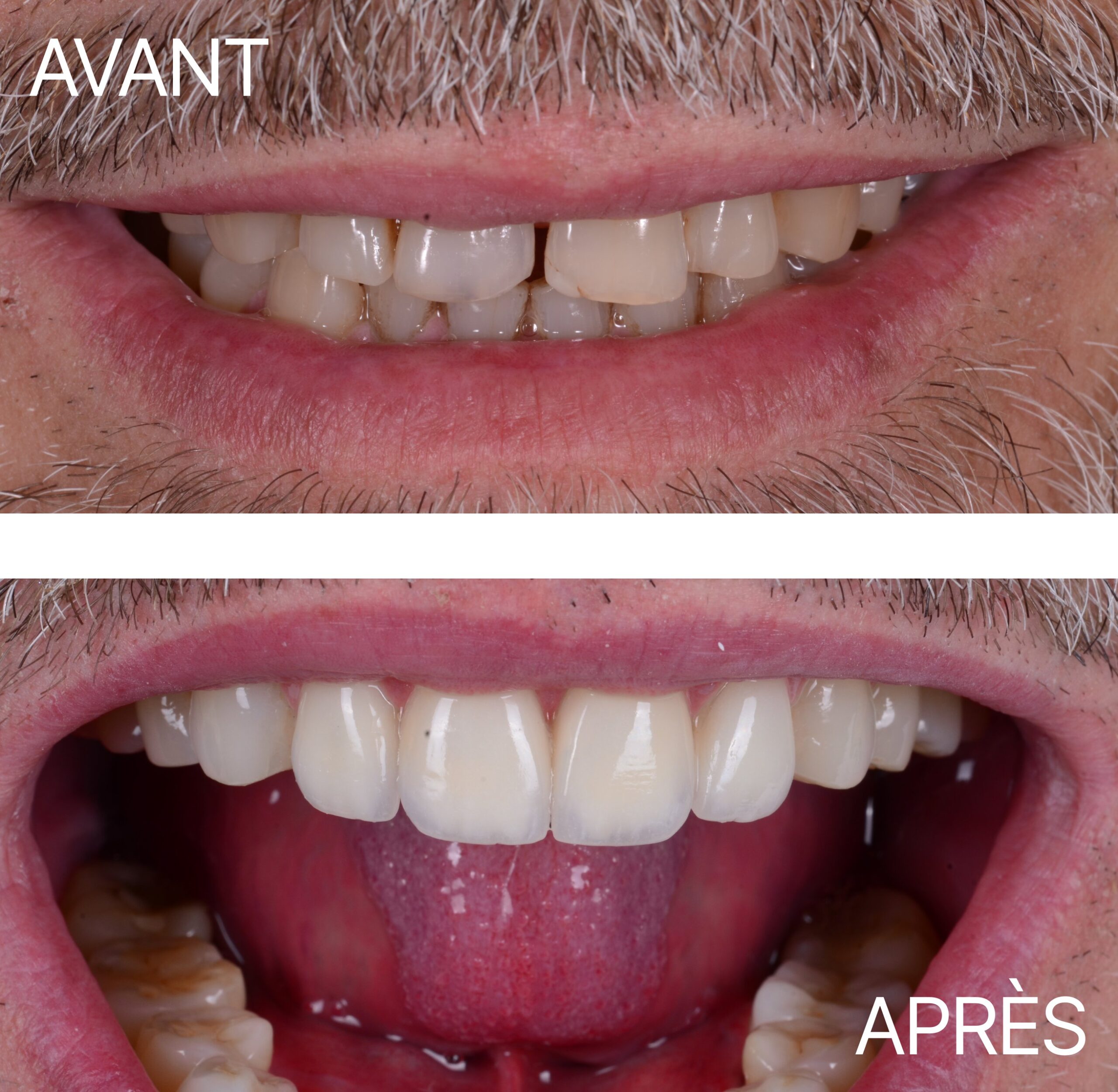 Lausanne Smile Avant Apres Cas Facette 6
