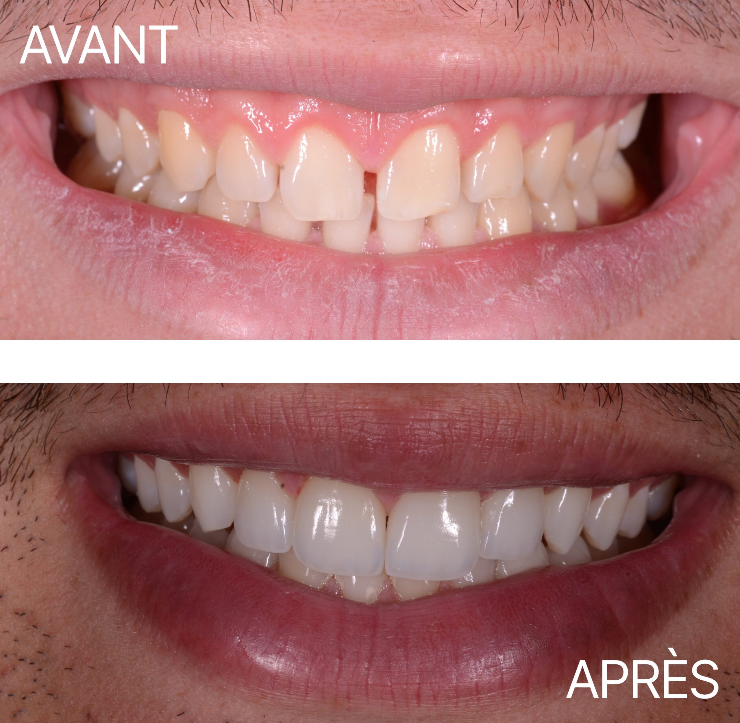Lausanne Smile Avant Apres Cas Facette 7