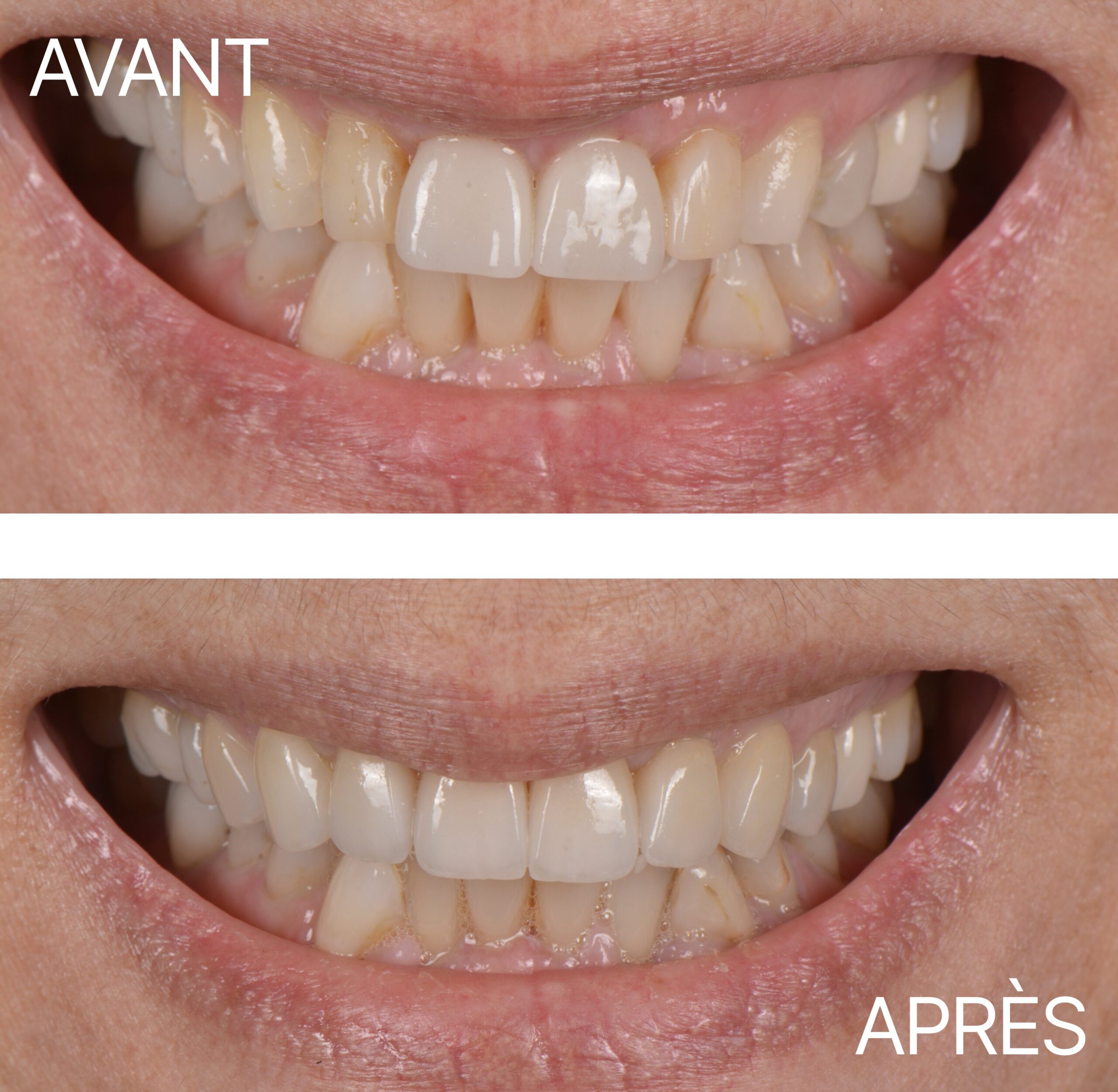 Lausanne Smile Avant Apres Cas Facette Encore