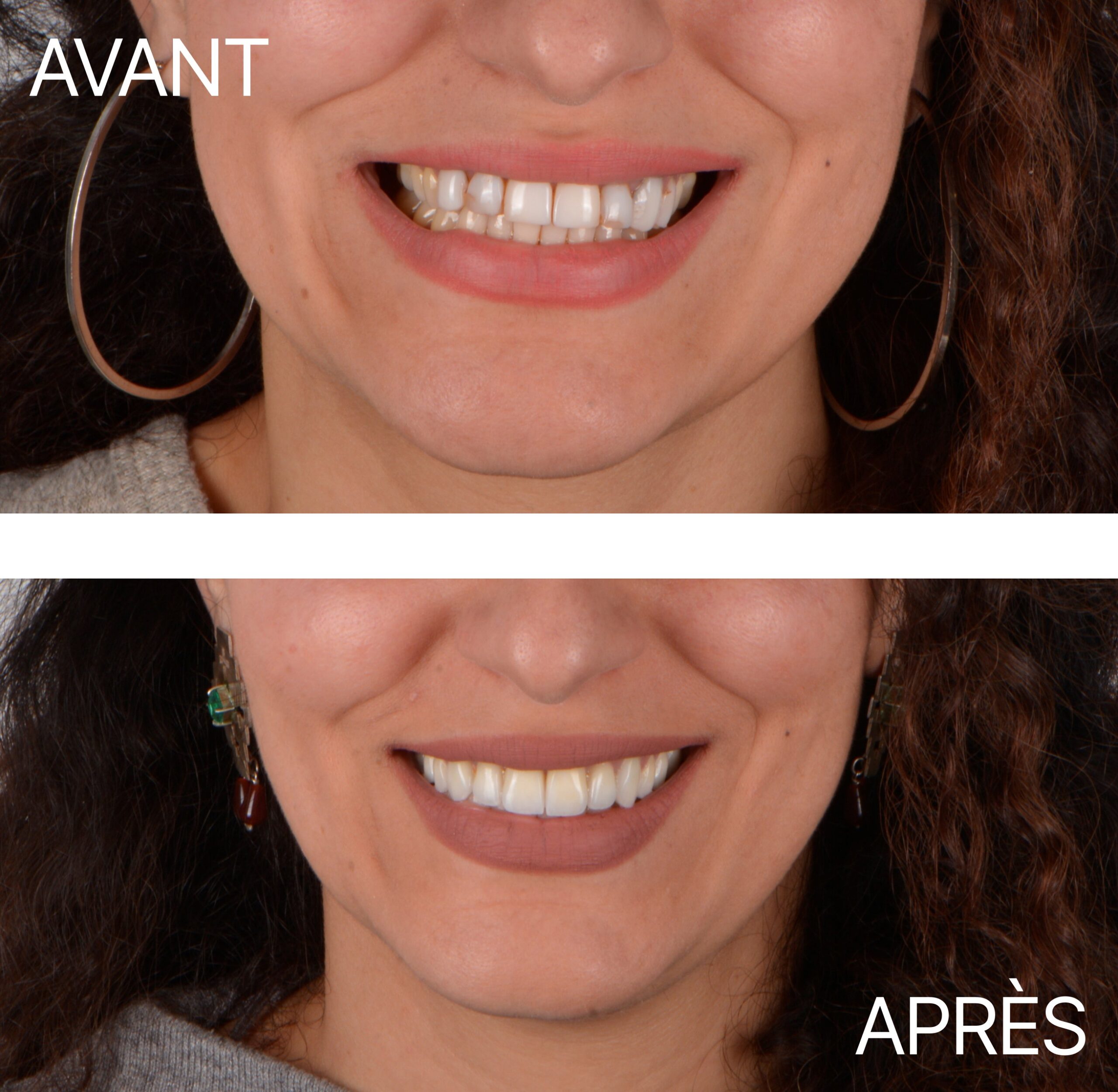 Lausanne Smile Avant Apres Cas Facette Visage
