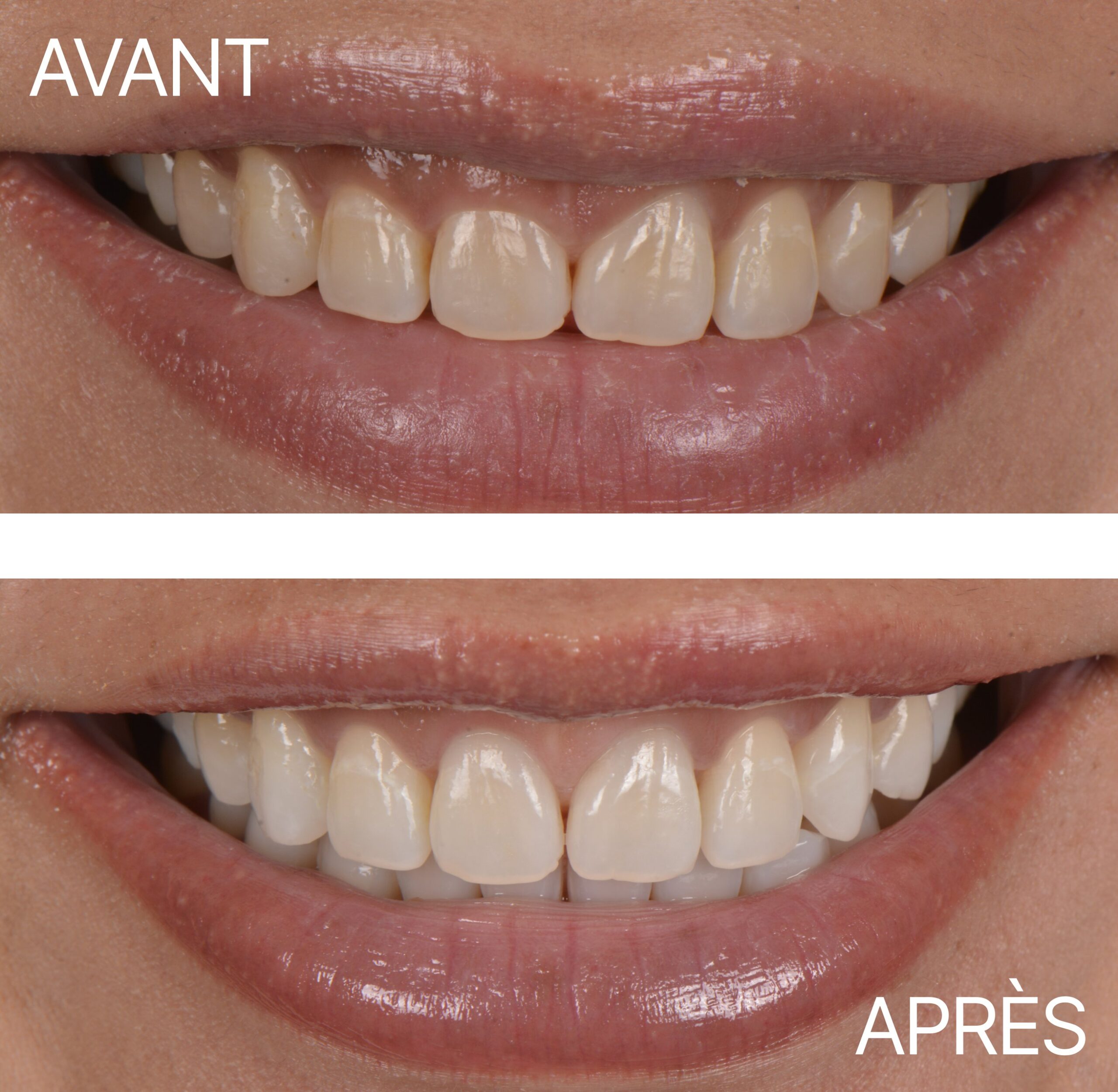 Lausanne Smile Avant Apres Cas Gum Lifting 1