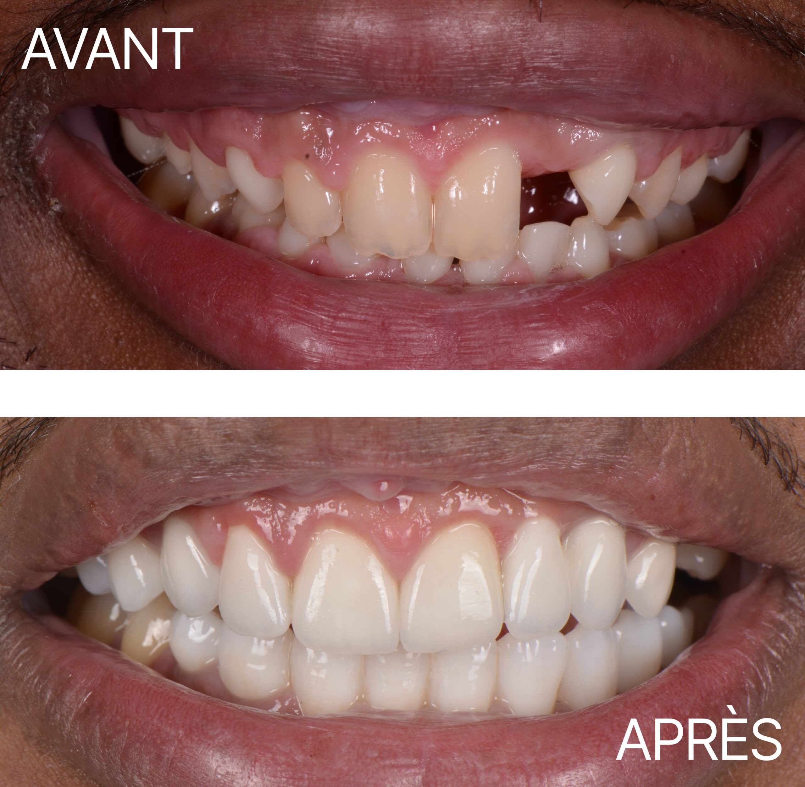 Lausanne Smile Avant Apres Cas Implant 10