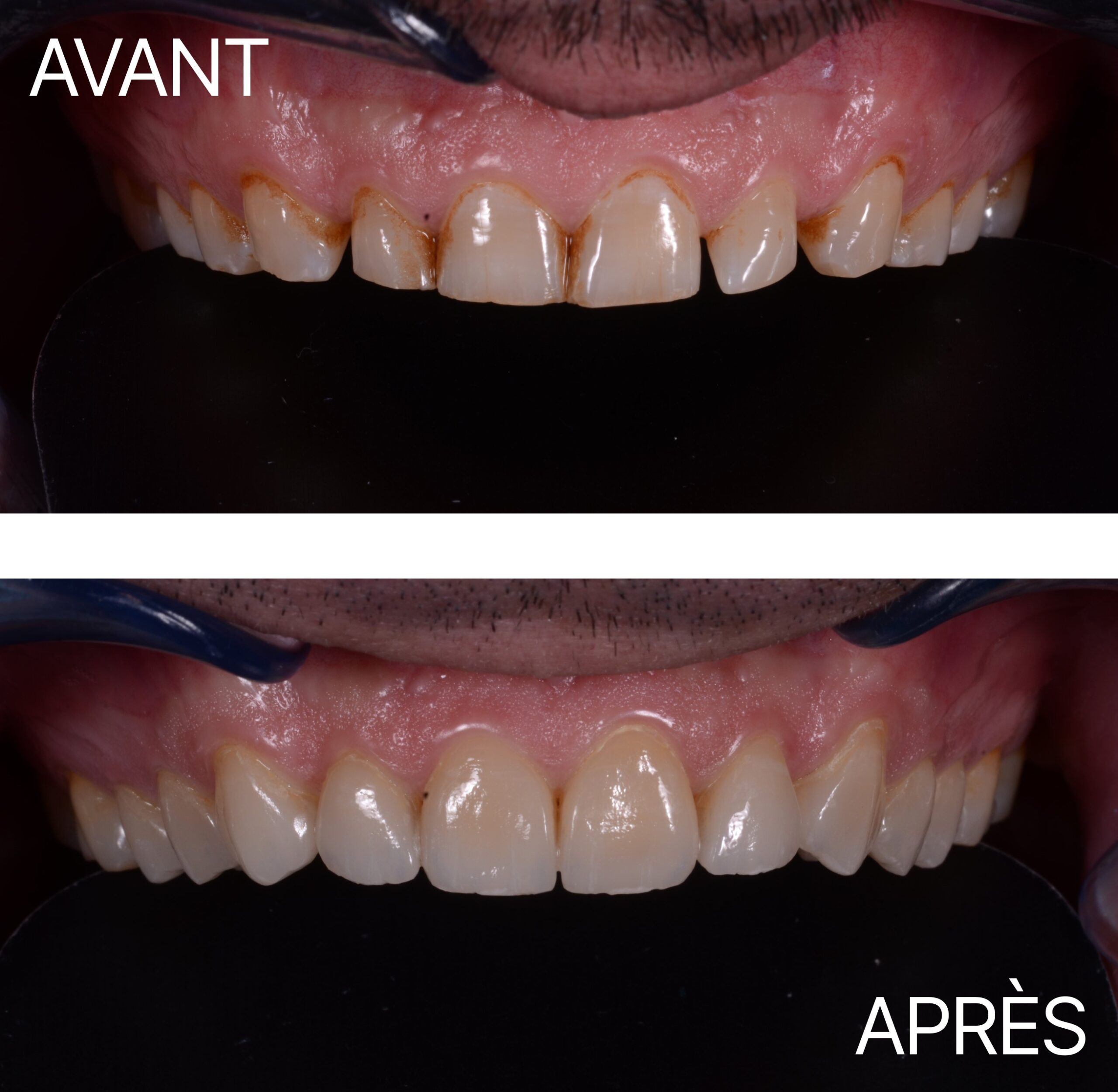 Lausanne Smile Avant Apres Cas Usure 2