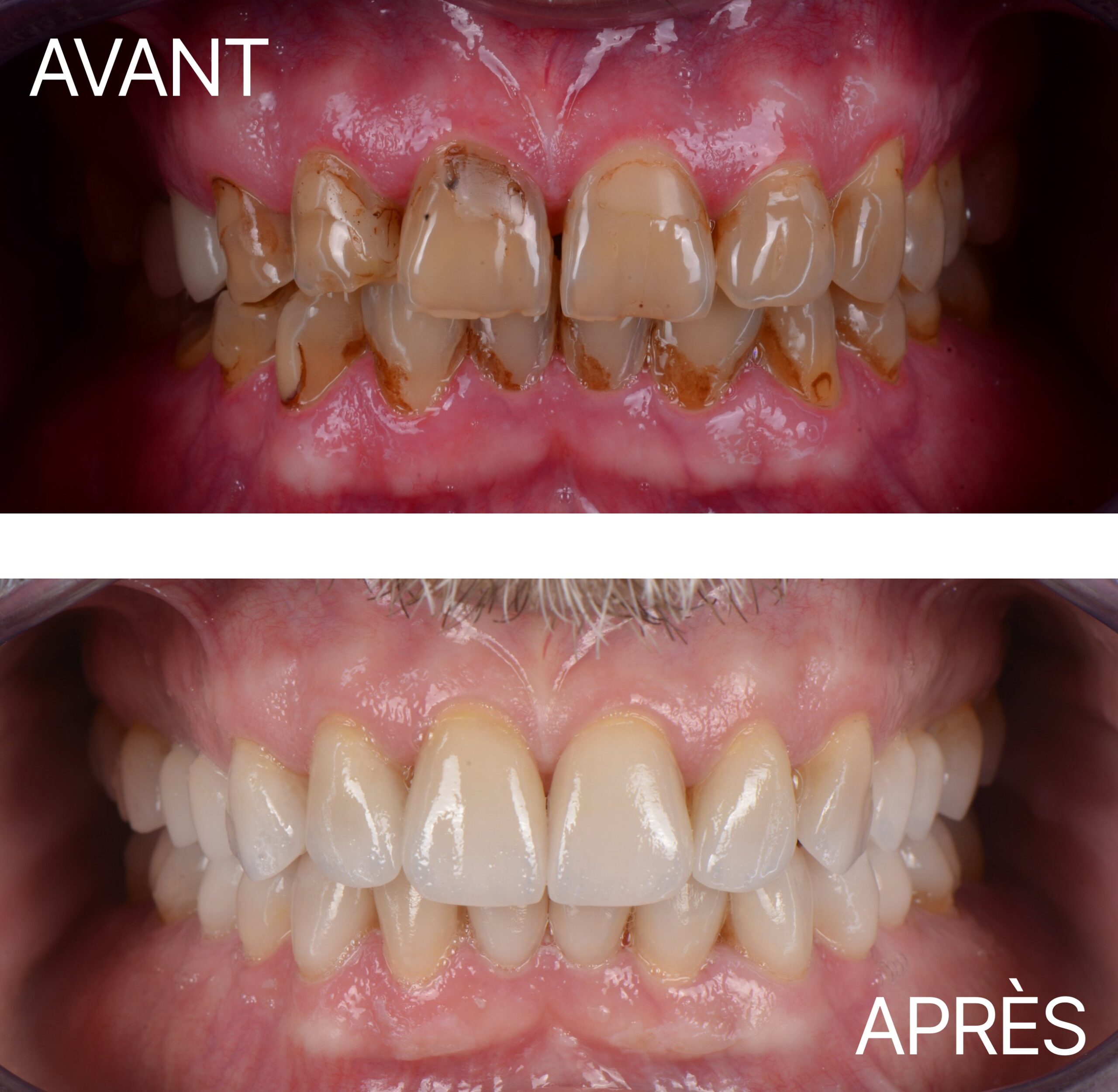 Lausanne Smile Avant Apres Cas Usure 3