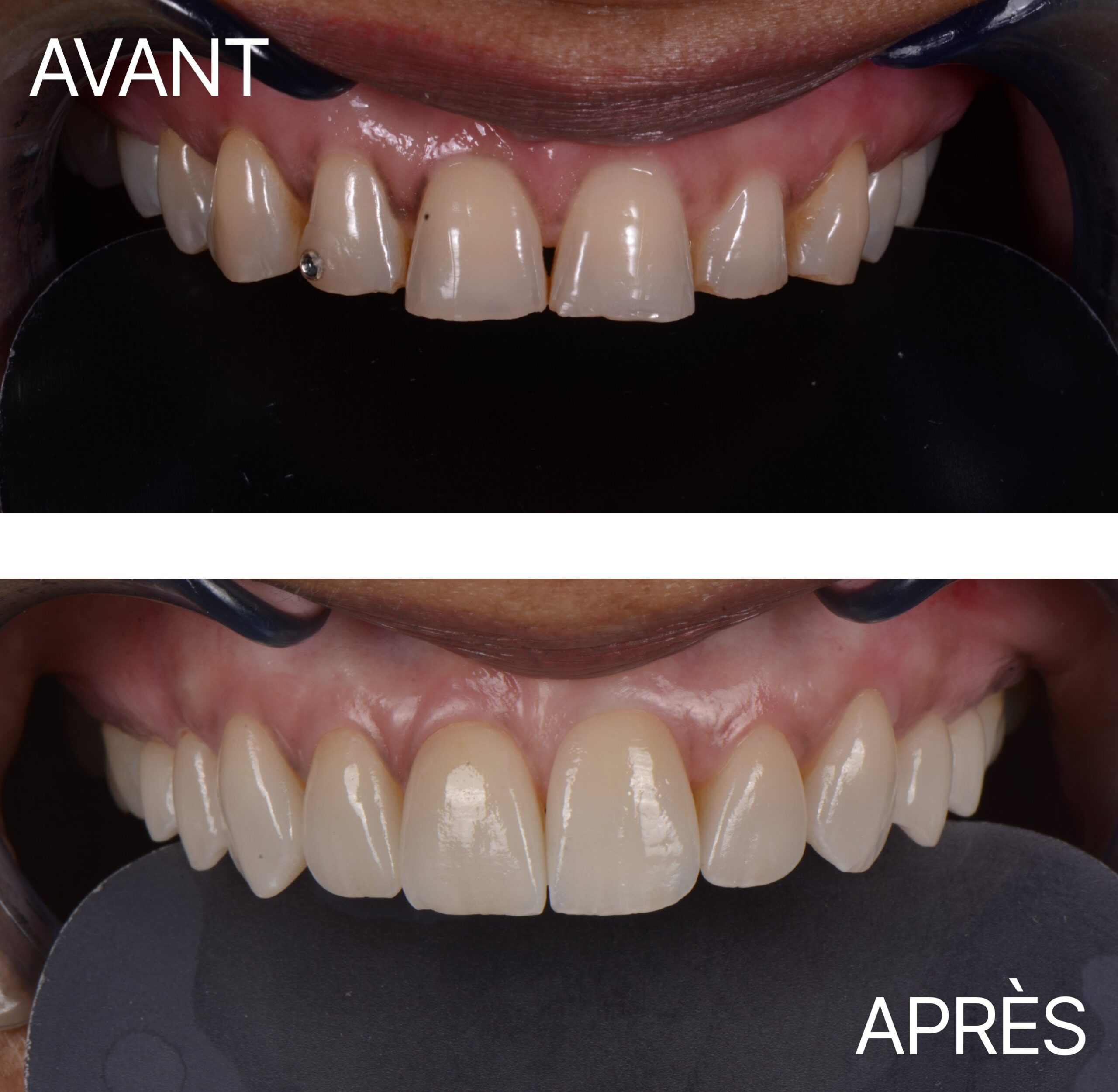 Lausanne Smile Avant Apres Cas Usure 4