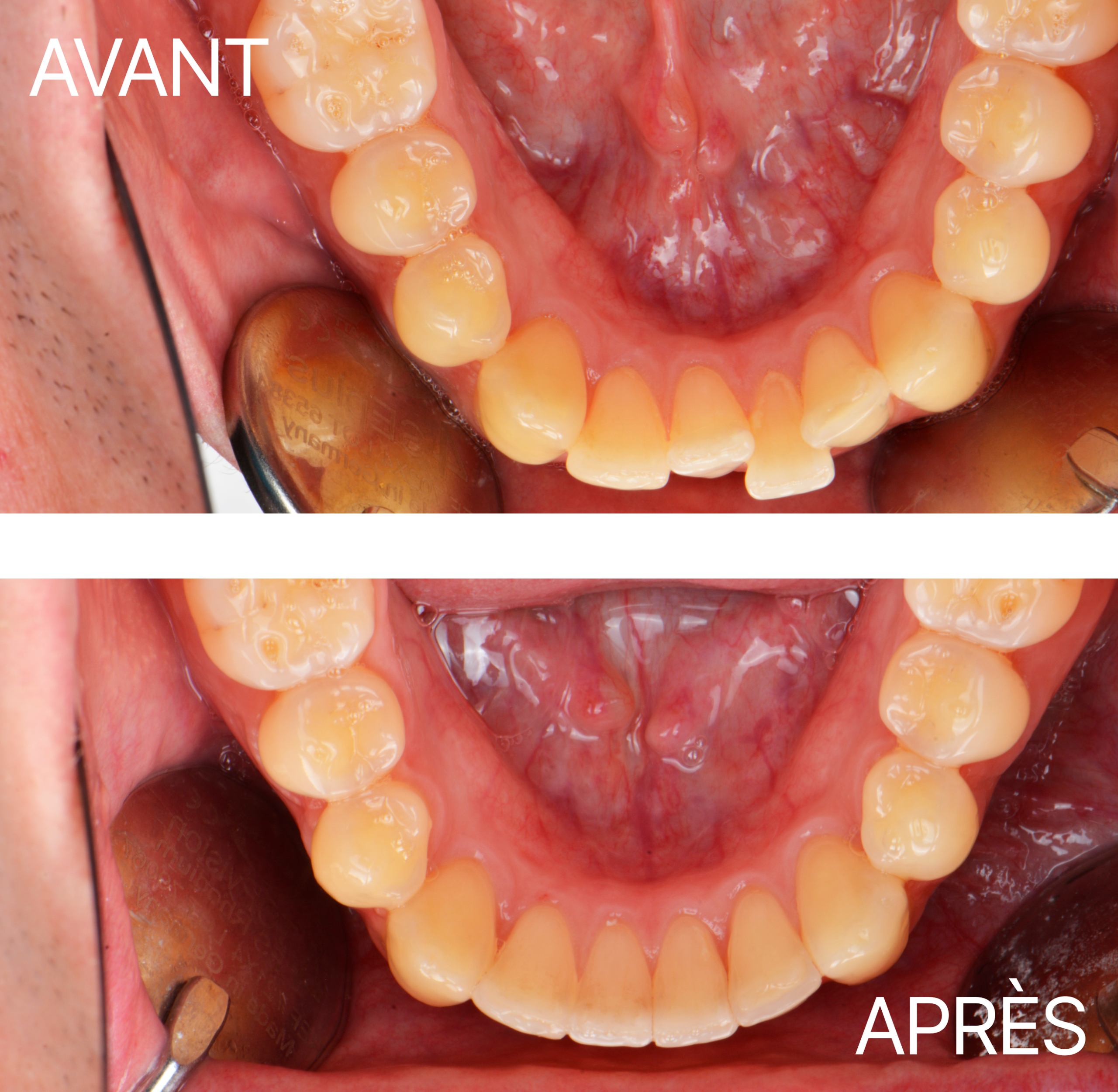 Avant Après Aligneur Ddm