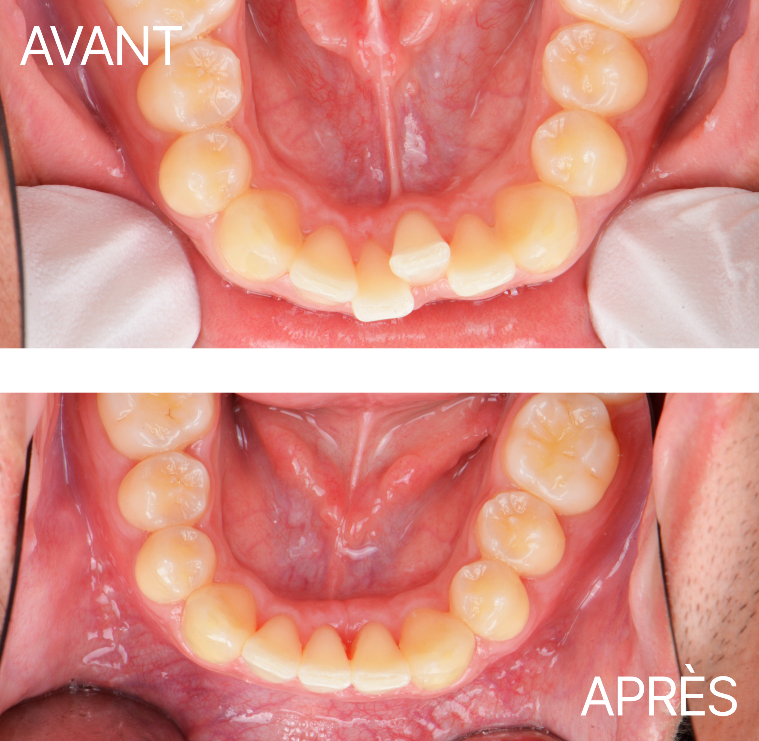 Avant Après Aligneur Ddm Severe