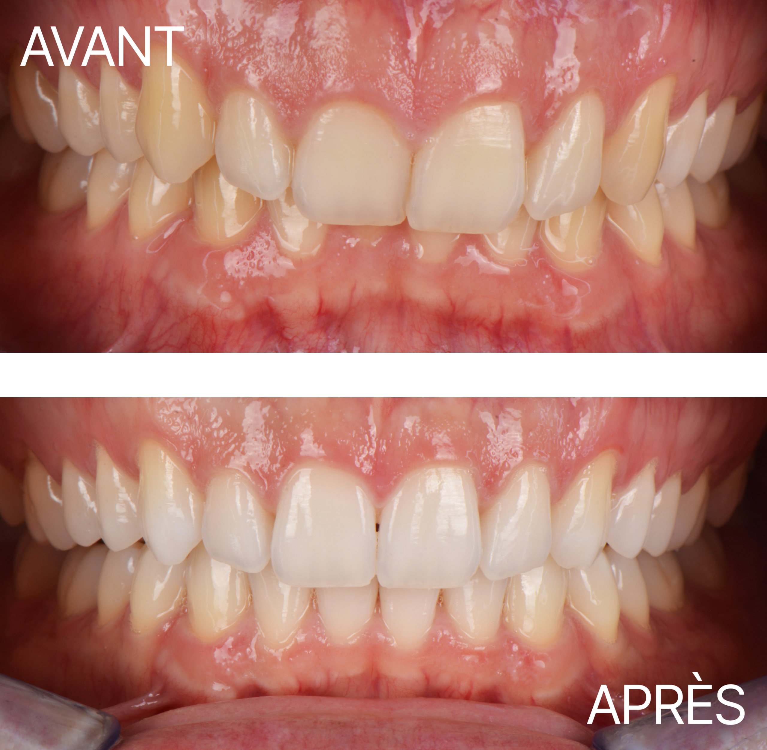 Avant Après Aligneur Deepbite