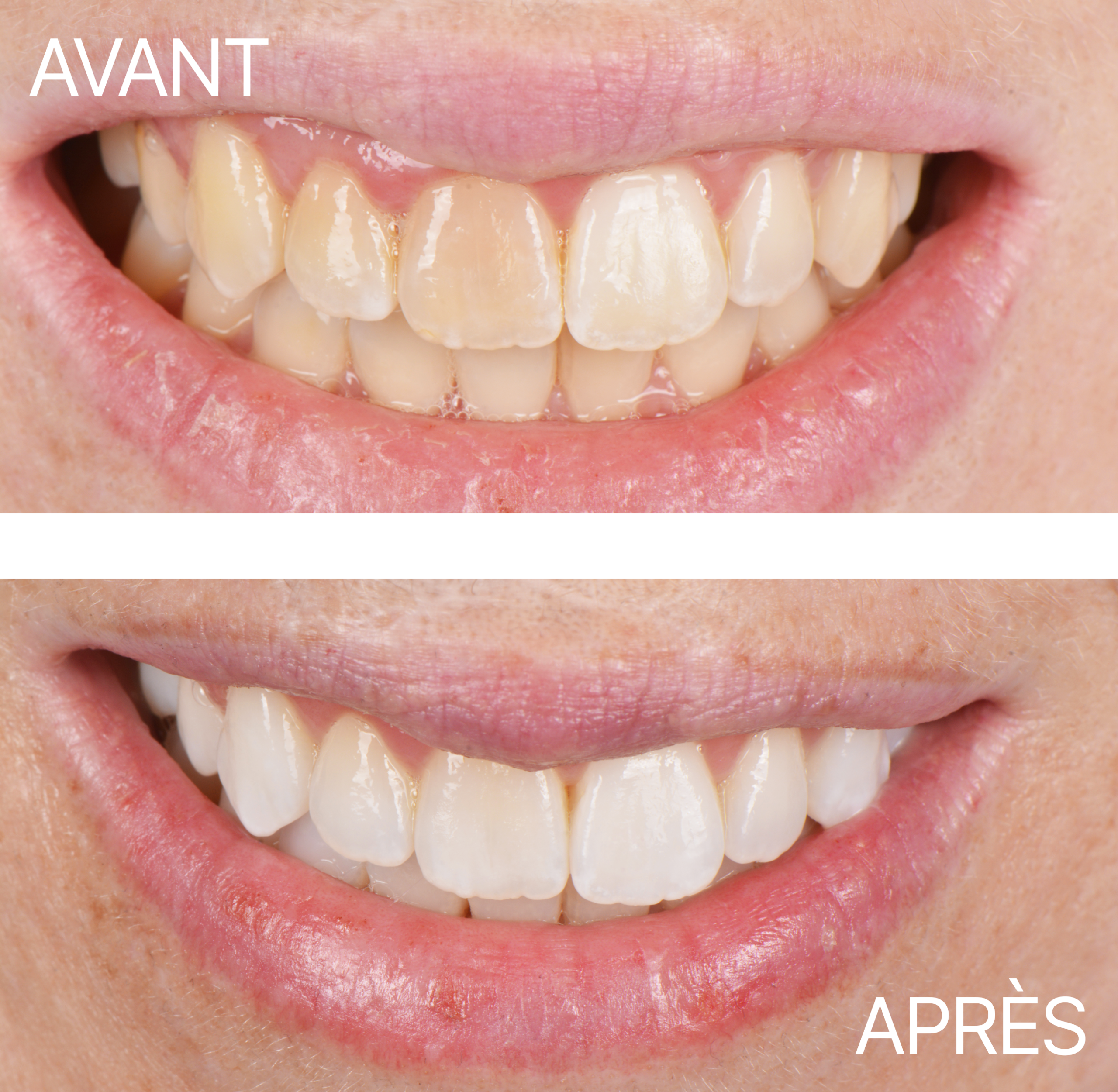 Avant Après Blanchiment Cas 2