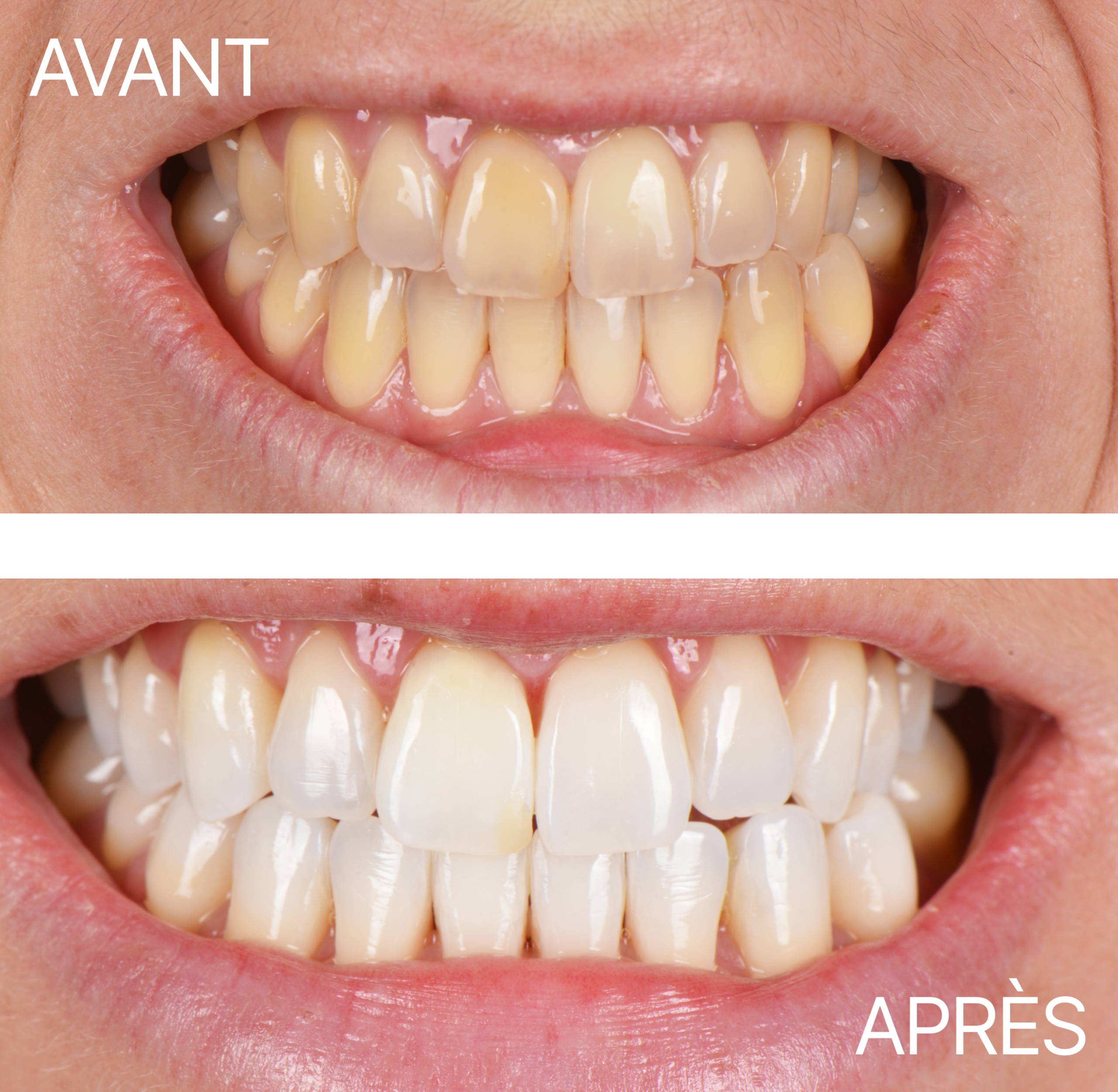 Avant Après Blanchiment Gouttiere 1