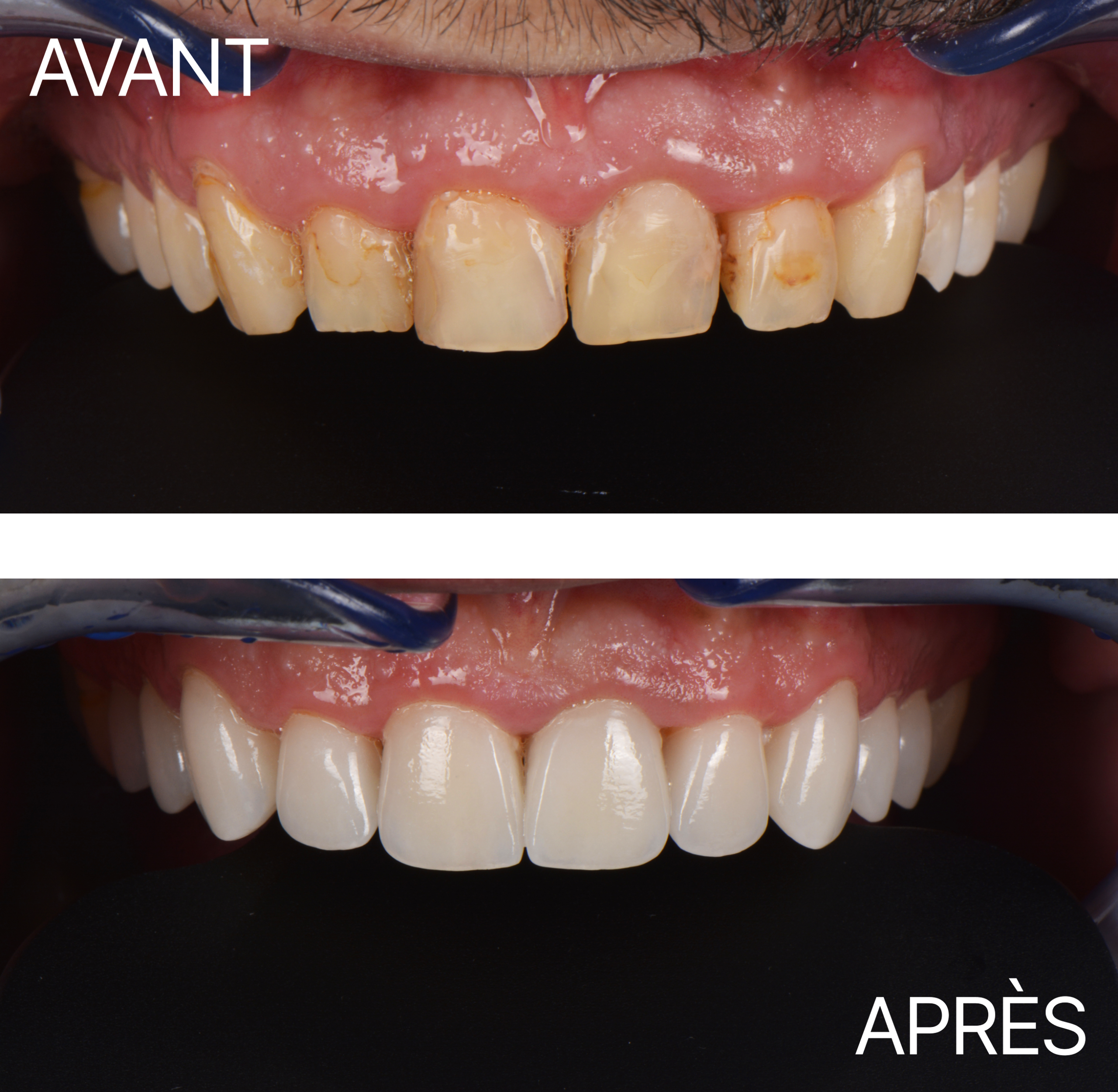 Avant Après Cas Facette 11