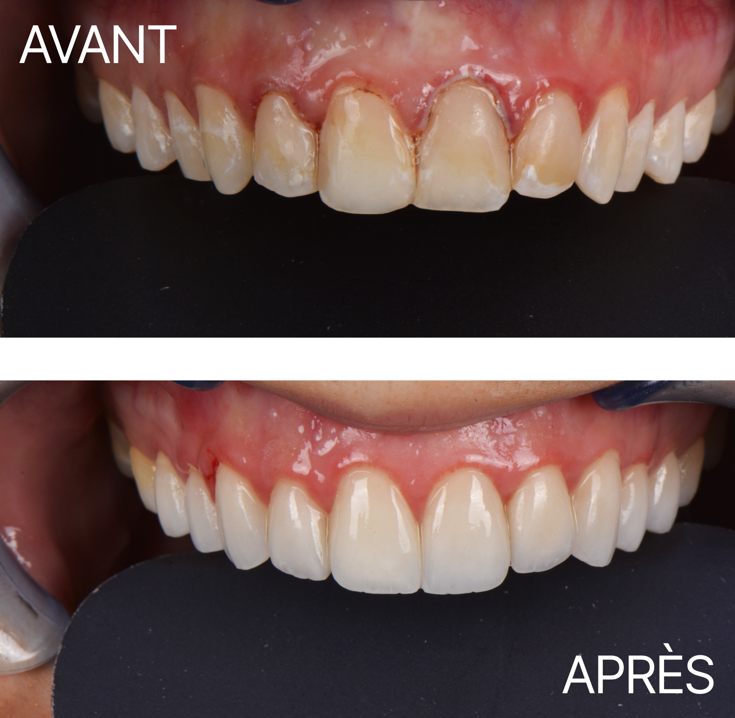 Avant Après Cas Facette 14