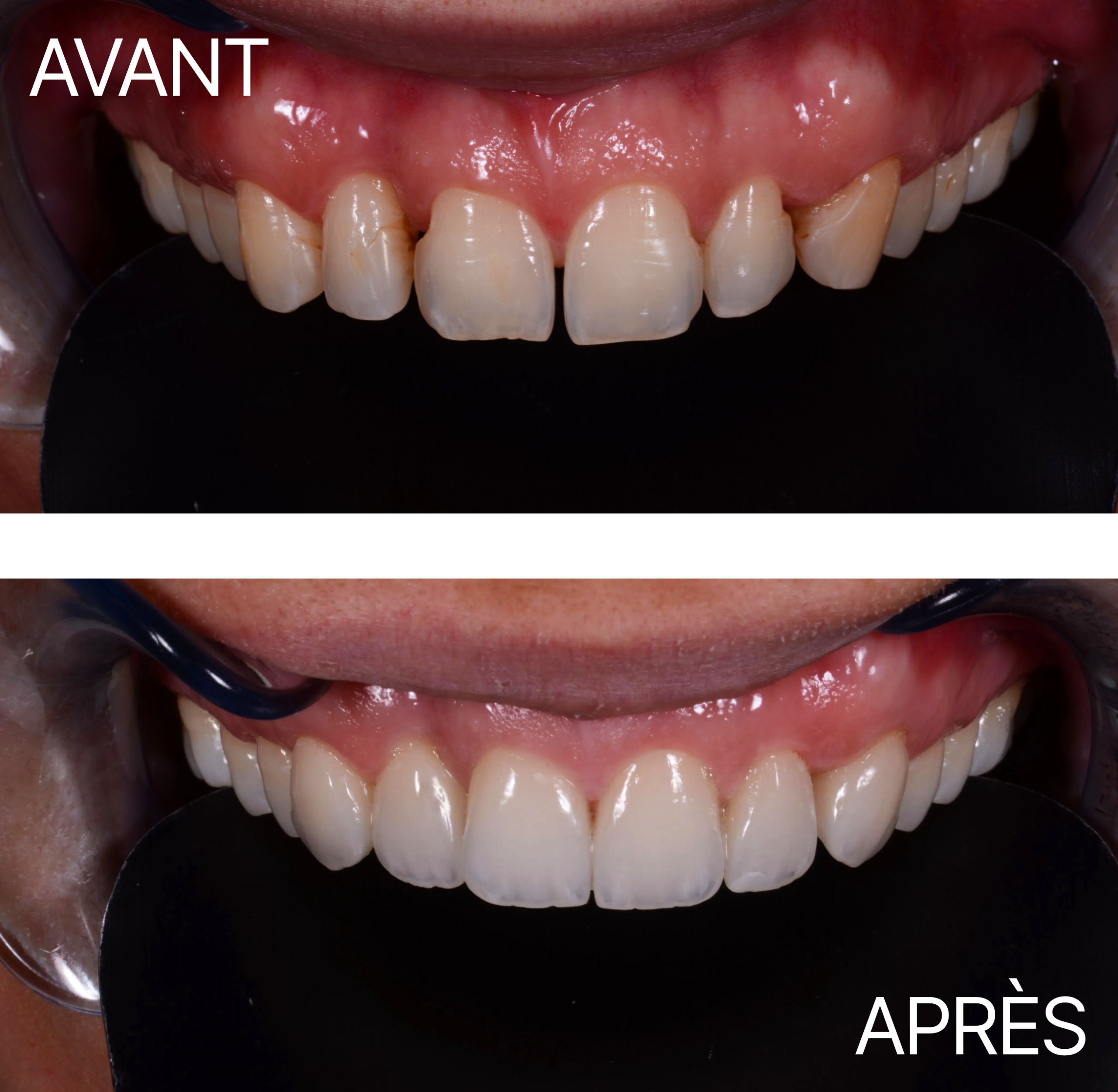 Avant Après Cas Facette 21