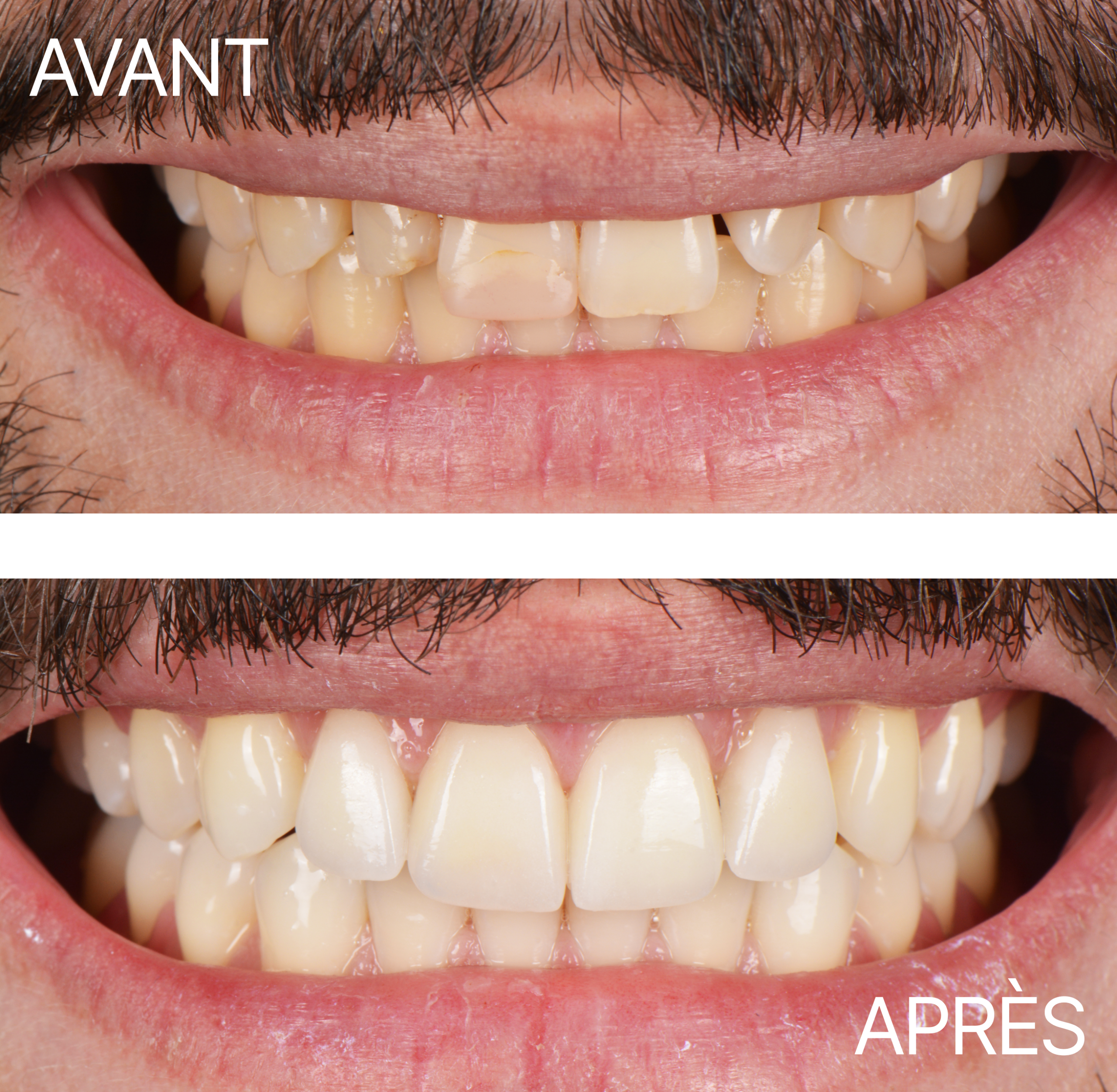 Avant Après Cas Facette 3