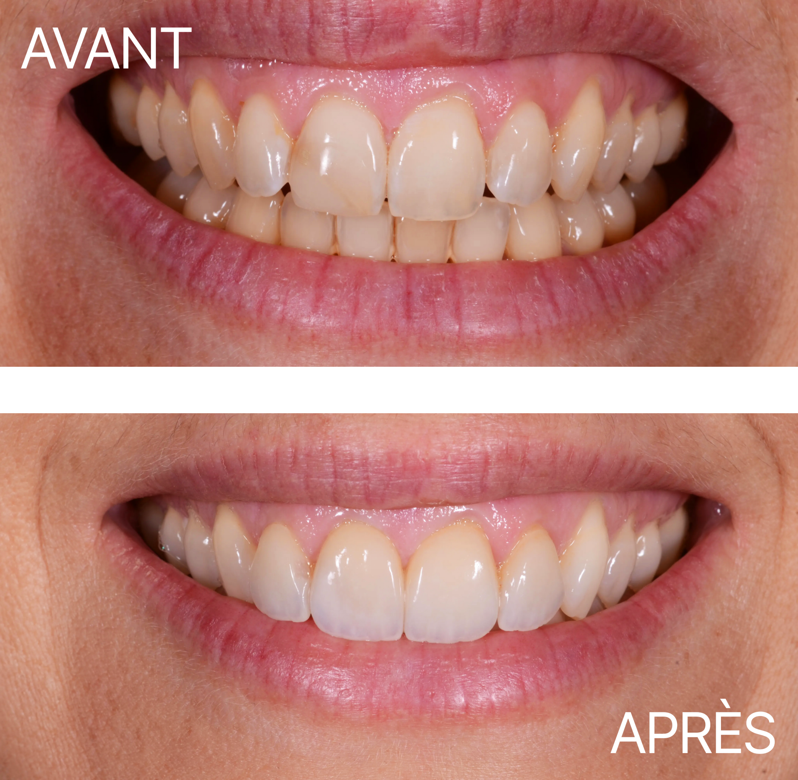 Avant Après Cas Facette 4