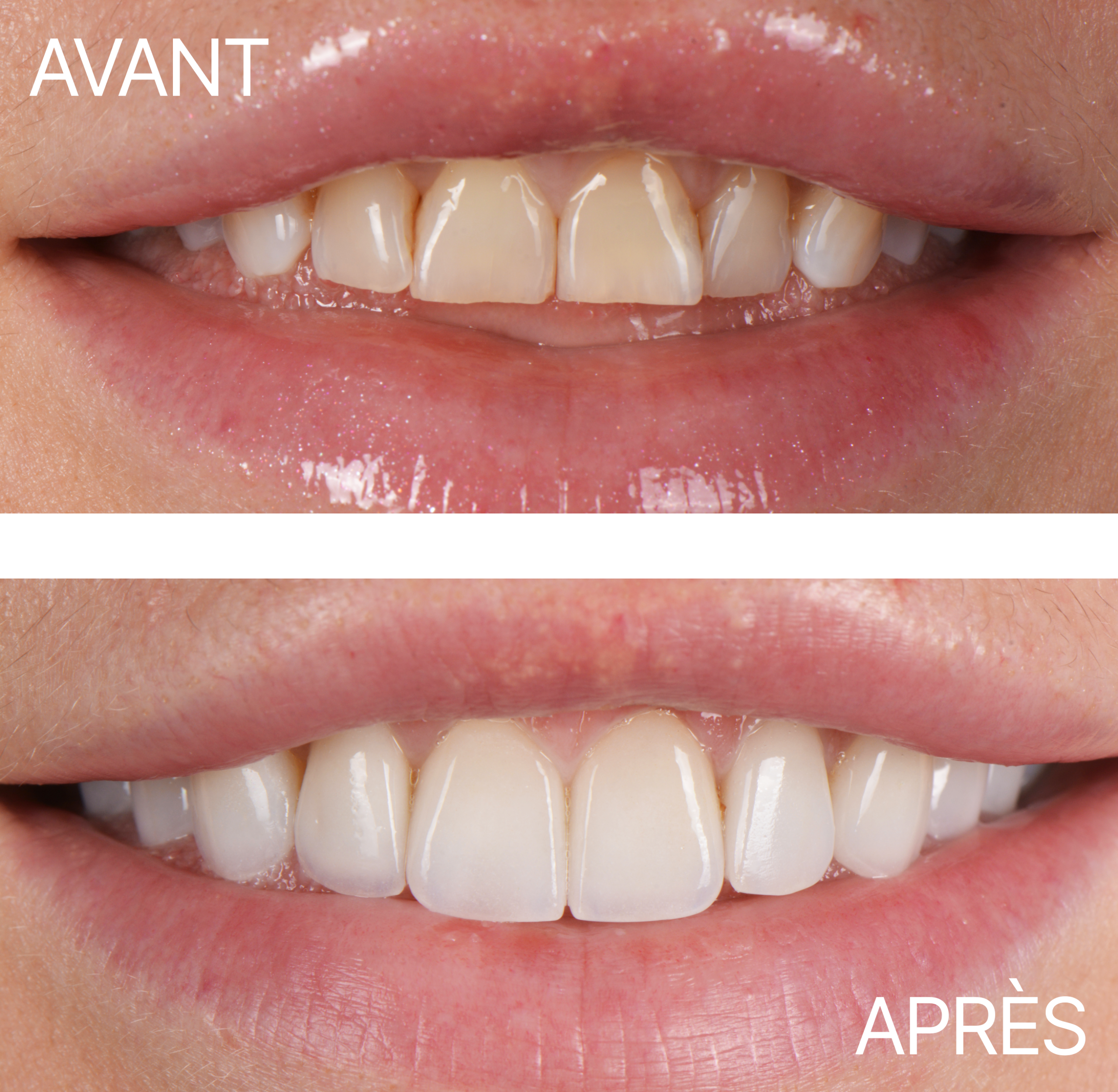 Avant Après Cas Facette 5