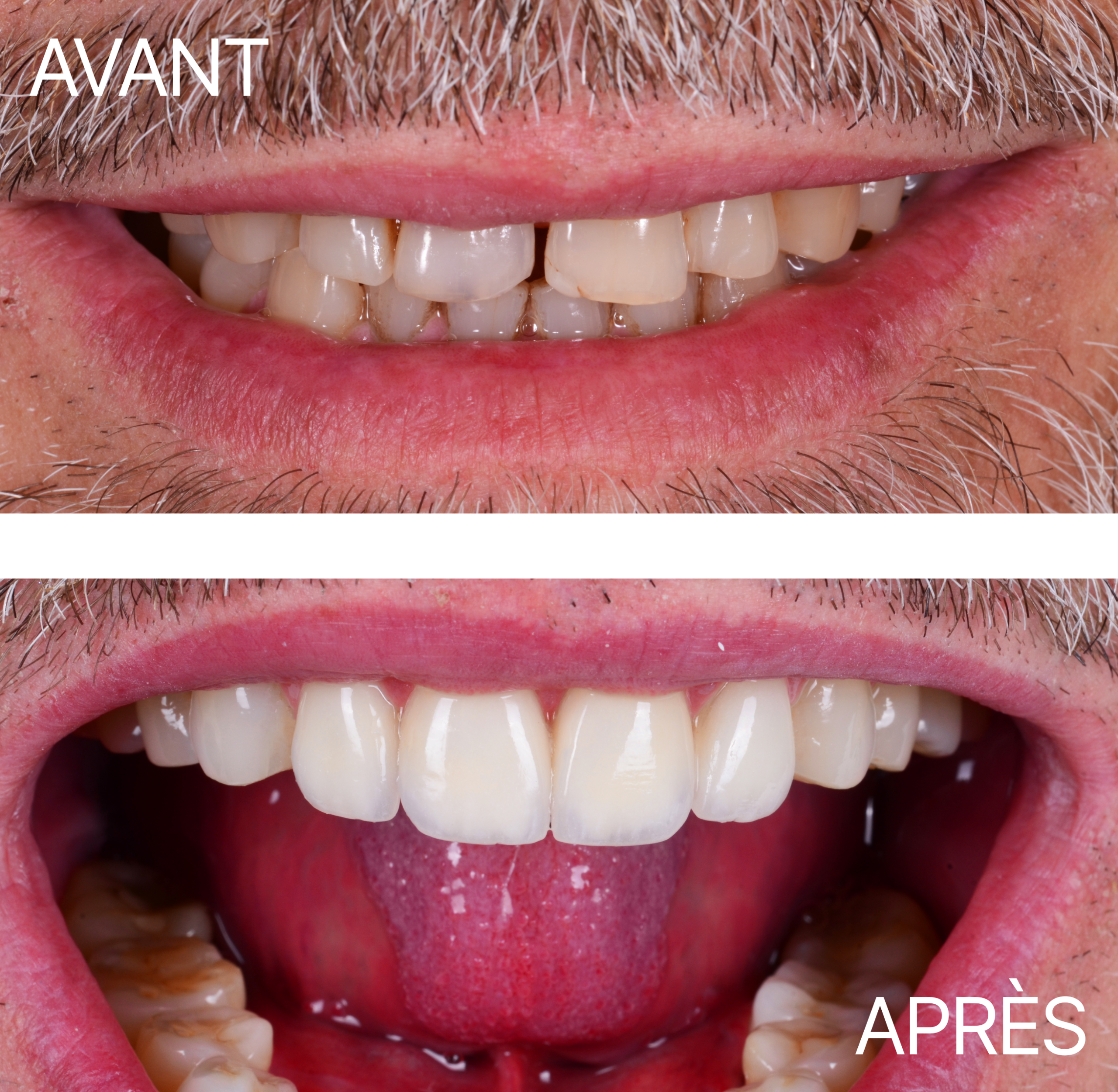 Avant Après Cas Facette 6