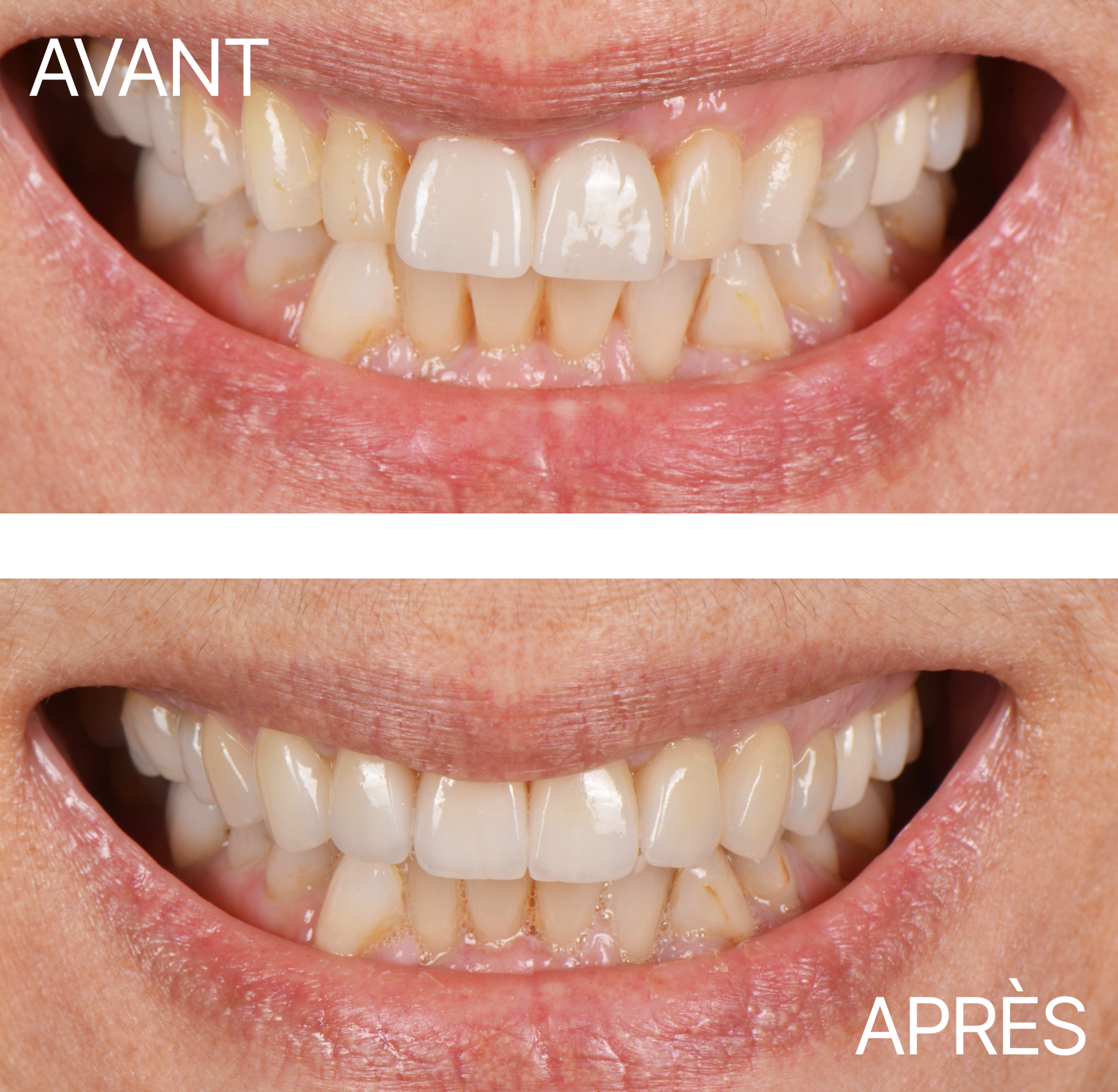 Avant Après Cas Facette Encore