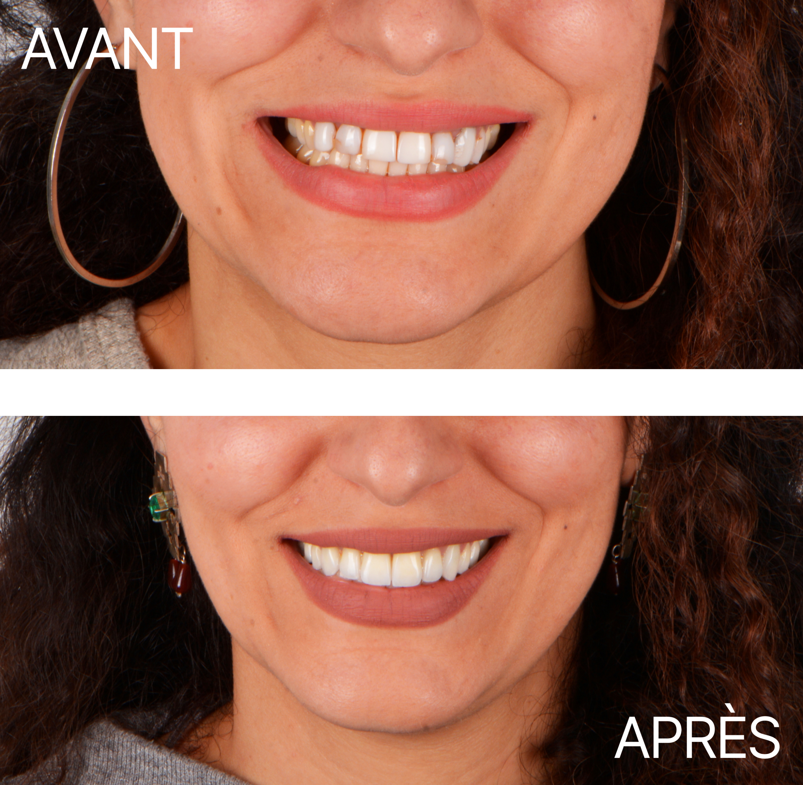 Avant Après Cas Facette Visage