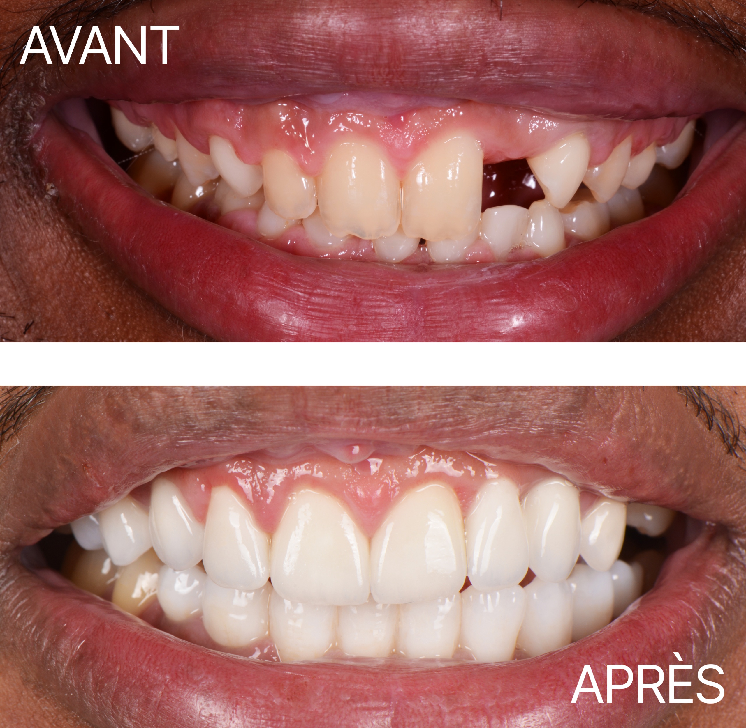 Avant Après Cas Implant 10