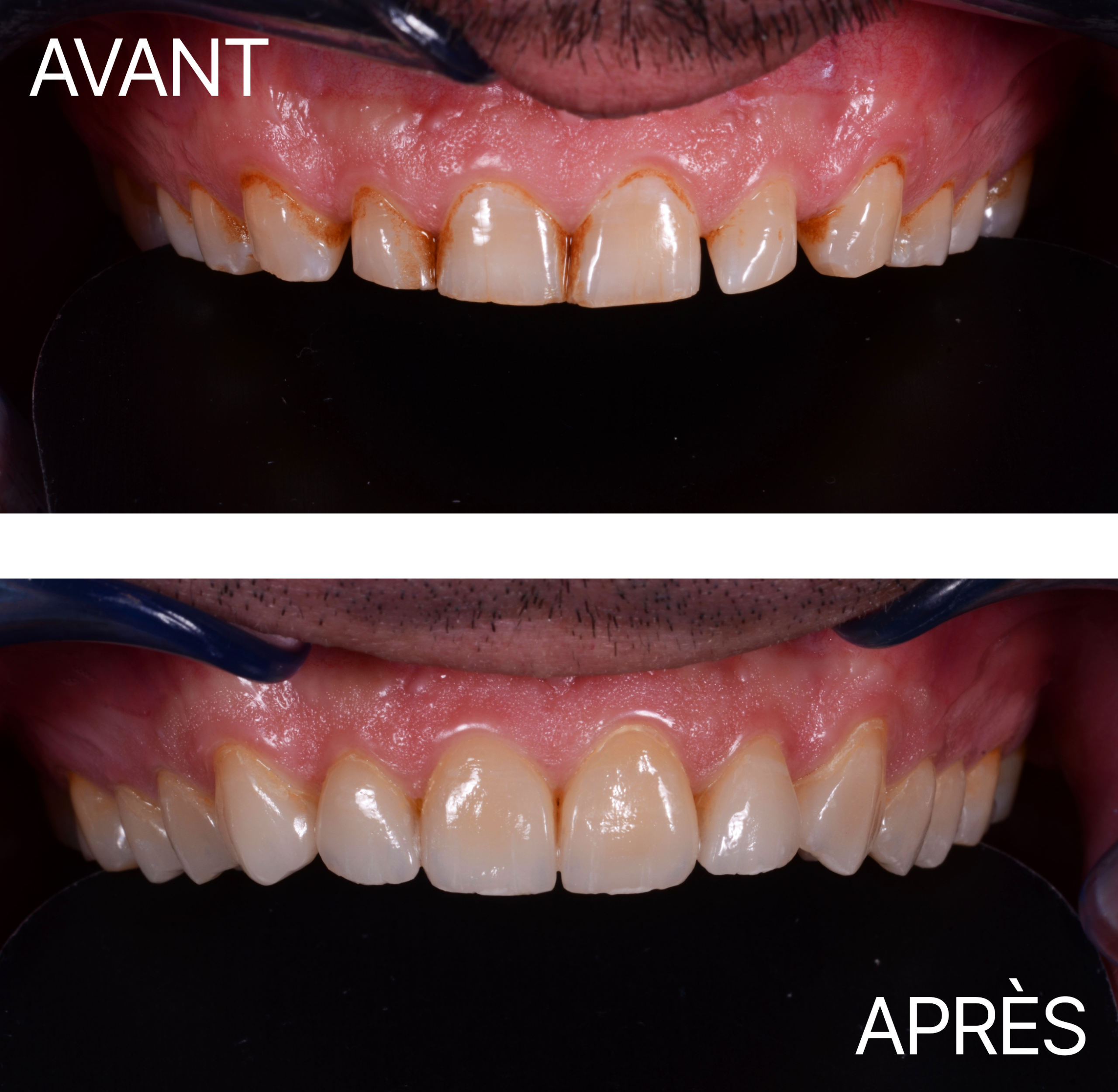 Avant Après Cas Usure 2