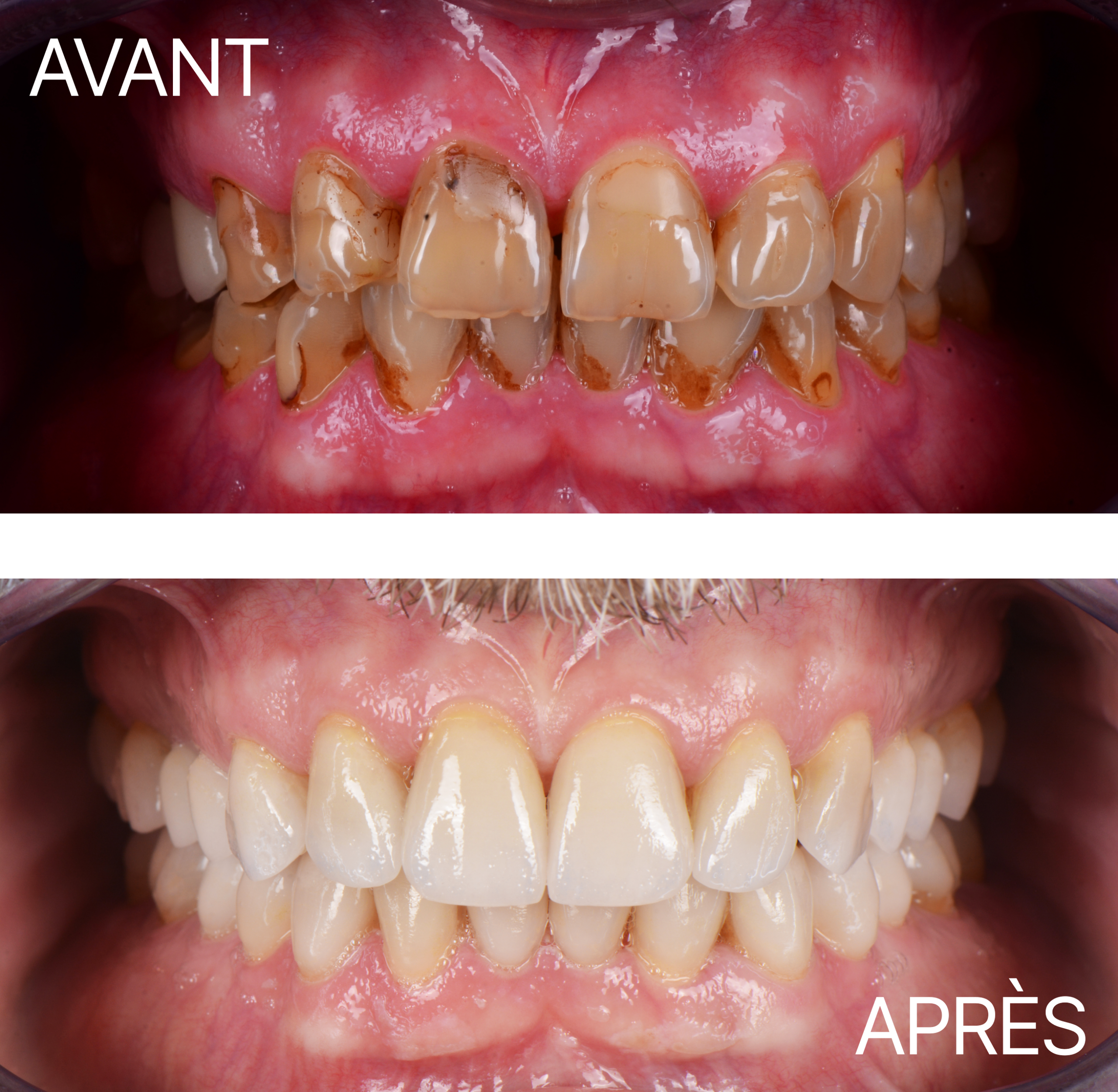 Avant Après Cas Usure 3