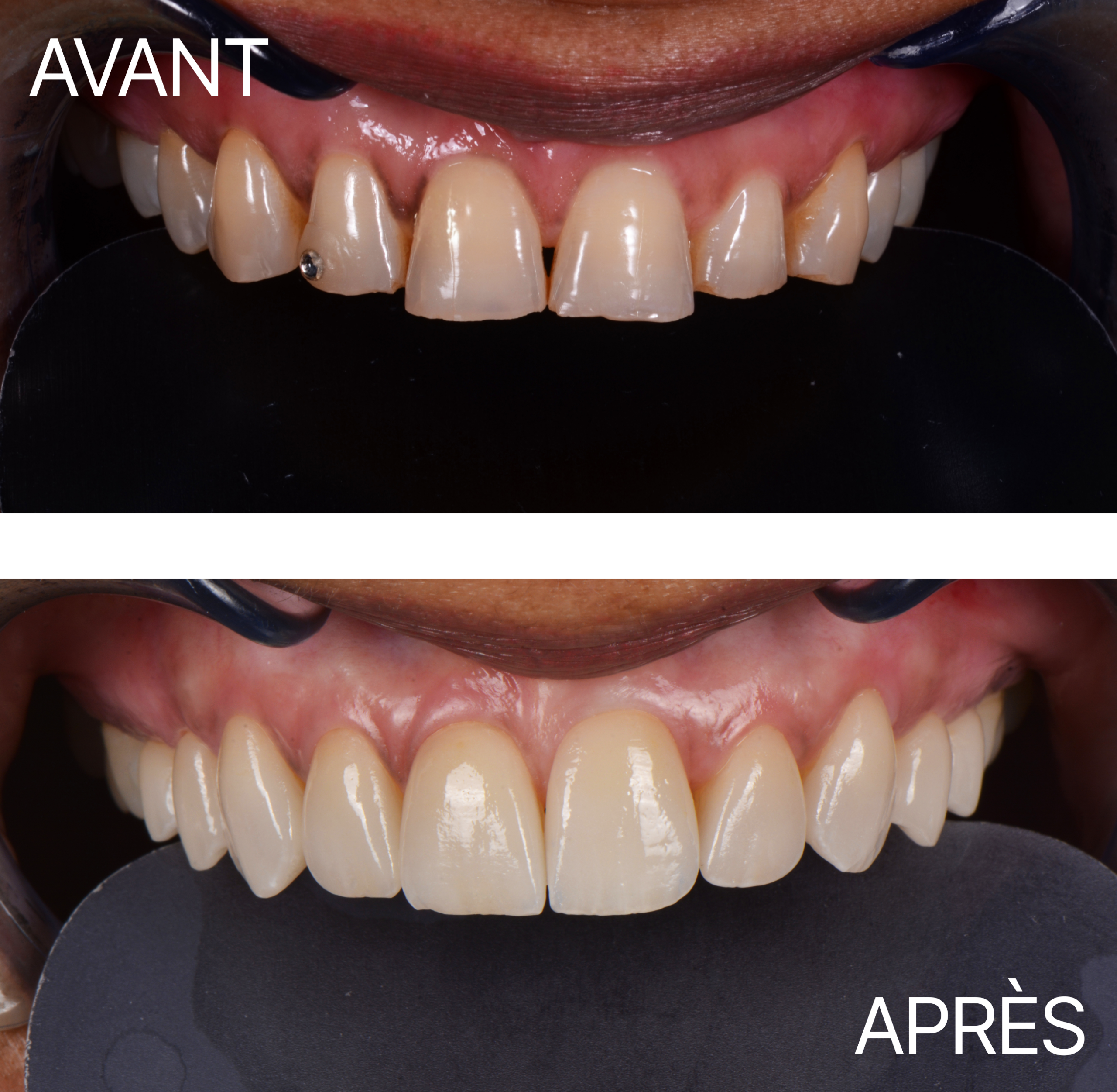 Avant Après Cas Usure 4