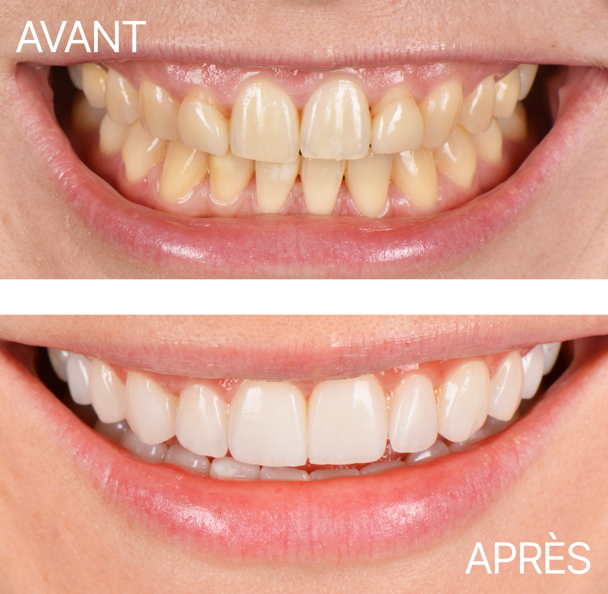 Avant Après Premier Cas Facette 2025